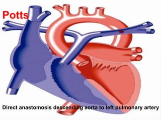 Potts
Direct anastomosis descending aorta to left pulmonary artery
 
