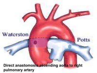 Direct anastomosis ascending aorta to right
pulmonary artery
 