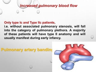 Increased pulmonary blood flow
Only type Ic and Type IIc patients,
i.e. without associated pulmonary stenosis, will fall
into the category of pulmonary plethora. A majority
of these patients will have type II anatomy and will
usually manifest during early infancy.
Pulmonary artery banding
 