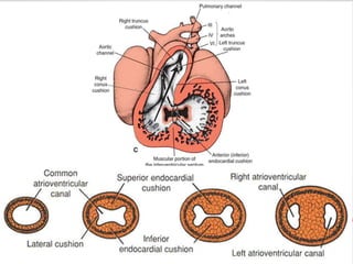 • Defined as congenital absence or
agenesis of the tricuspid valve,
with no direct communication
between the right atrium and right
ventricle.
• Incidence : 0.06 per 1000 live
births
• Prevalence :in clinical series of
congenital heart disease is 1- 2.4
%.
 