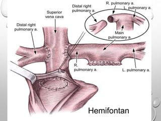 Hemifontan
 
