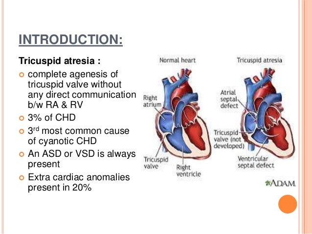 tricuspid atresia