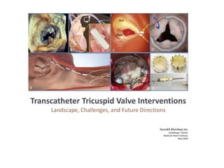 Transcatheter Tricuspid Valve Interventions
Landscape, Challenges, and Future Directions
Saurabh Bhardwaj MD,
Cardiology Trainee,
National Heart Institute,
New Delhi
 