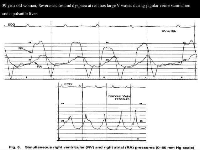 Right Ventricular Pressure Tracing Patient 9 Thin Arrow Download Scientific Diagram