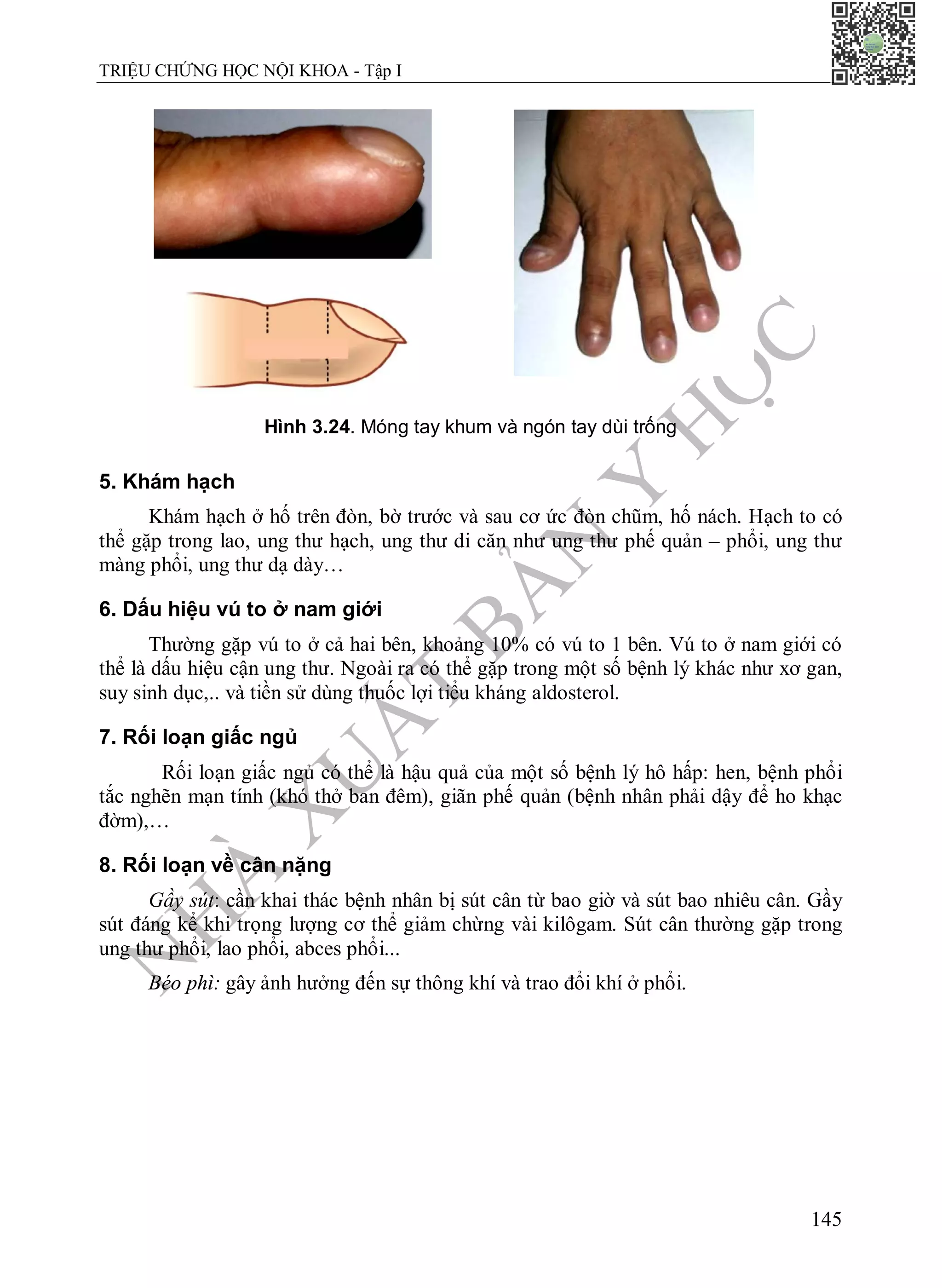 N
H
À
X
U
Ấ
T
B
Ả
N
Y
H
Ọ
C
TRIỆU CHỨNG HỌC NỘI KHOA - Tập I
145
Hình 3.24. Móng tay khum và ngón tay dùi trống
5. Khám hạch
Khám hạch ở hố trên đòn, bờ trước và sau cơ ức đòn chũm, hố nách. Hạch to có
thể gặp trong lao, ung thư hạch, ung thư di căn như ung thư phế quản – phổi, ung thư
màng phổi, ung thư dạ dày…
6. Dấu hiệu vú to ở nam giới
Thường gặp vú to ở cả hai bên, khoảng 10% có vú to 1 bên. Vú to ở nam giới có
thể là dấu hiệu cận ung thư. Ngoài ra có thể gặp trong một số bệnh lý khác như xơ gan,
suy sinh dục,.. và tiền sử dùng thuốc lợi tiểu kháng aldosterol.
7. Rối loạn giấc ngủ
Rối loạn giấc ngủ có thể là hậu quả của một số bệnh lý hô hấp: hen, bệnh phổi
tắc nghẽn mạn tính (khó thở ban đêm), giãn phế quản (bệnh nhân phải dậy để ho khạc
đờm),…
8. Rối loạn về cân nặng
Gầy sút: cần khai thác bệnh nhân bị sút cân từ bao giờ và sút bao nhiêu cân. Gầy
sút đáng kể khi trọng lượng cơ thể giảm chừng vài kilôgam. Sút cân thường gặp trong
ung thư phổi, lao phổi, abces phổi...
Béo phì: gây ảnh hưởng đến sự thông khí và trao đổi khí ở phổi.
 