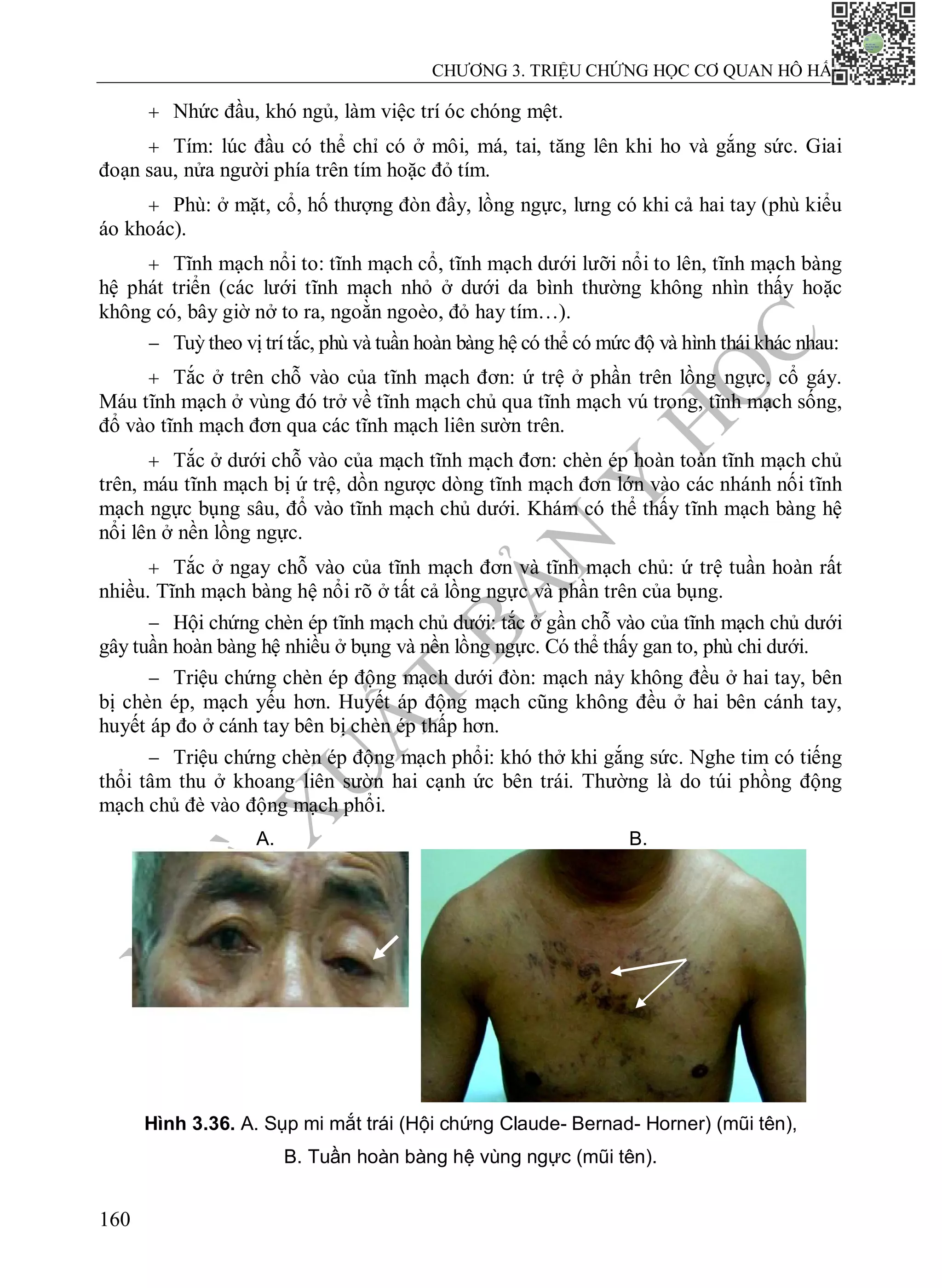 N
H
À
X
U
Ấ
T
B
Ả
N
Y
H
Ọ
C
CHƯƠNG 3. TRIỆU CHỨNG HỌC CƠ QUAN HÔ HẤP
160
 Nhức đầu, khó ngủ, làm việc trí óc chóng mệt.
 Tím: lúc đầu có thể chỉ có ở môi, má, tai, tăng lên khi ho và gắng sức. Giai
đoạn sau, nửa người phía trên tím hoặc đỏ tím.
 Phù: ở mặt, cổ, hố thượng đòn đầy, lồng ngực, lưng có khi cả hai tay (phù kiểu
áo khoác).
 Tĩnh mạch nổi to: tĩnh mạch cổ, tĩnh mạch dưới lưỡi nổi to lên, tĩnh mạch bàng
hệ phát triển (các lưới tĩnh mạch nhỏ ở dưới da bình thường không nhìn thấy hoặc
không có, bây giờ nở to ra, ngoằn ngoèo, đỏ hay tím…).
 Tuỳ theo vị trítắc, phù và tuần hoàn bàng hệ có thể có mức độ và hình thái khác nhau:
 Tắc ở trên chỗ vào của tĩnh mạch đơn: ứ trệ ở phần trên lồng ngực, cổ gáy.
Máu tĩnh mạch ở vùng đó trở về tĩnh mạch chủ qua tĩnh mạch vú trong, tĩnh mạch sống,
đổ vào tĩnh mạch đơn qua các tĩnh mạch liên sườn trên.
 Tắc ở dưới chỗ vào của mạch tĩnh mạch đơn: chèn ép hoàn toàn tĩnh mạch chủ
trên, máu tĩnh mạch bị ứ trệ, dồn ngược dòng tĩnh mạch đơn lớn vào các nhánh nối tĩnh
mạch ngực bụng sâu, đổ vào tĩnh mạch chủ dưới. Khám có thể thấy tĩnh mạch bàng hệ
nổi lên ở nền lồng ngực.
 Tắc ở ngay chỗ vào của tĩnh mạch đơn và tĩnh mạch chủ: ứ trệ tuần hoàn rất
nhiều. Tĩnh mạch bàng hệ nổi rõ ở tất cả lồng ngực và phần trên của bụng.
 Hội chứng chèn ép tĩnh mạch chủ dưới: tắc ở gần chỗ vào của tĩnh mạch chủ dưới
gây tuần hoàn bàng hệ nhiều ở bụng và nền lồng ngực. Có thể thấy gan to, phù chi dưới.
 Triệu chứng chèn ép động mạch dưới đòn: mạch nảy không đều ở hai tay, bên
bị chèn ép, mạch yếu hơn. Huyết áp động mạch cũng không đều ở hai bên cánh tay,
huyết áp đo ở cánh tay bên bị chèn ép thấp hơn.
 Triệu chứng chèn ép động mạch phổi: khó thở khi gắng sức. Nghe tim có tiếng
thổi tâm thu ở khoang liên sườn hai cạnh ức bên trái. Thường là do túi phồng động
mạch chủ đè vào động mạch phổi.
A. B.
Hình 3.36. A. Sụp mi mắt trái (Hội chứng Claude- Bernad- Horner) (mũi tên),
B. Tuần hoàn bàng hệ vùng ngực (mũi tên).
 