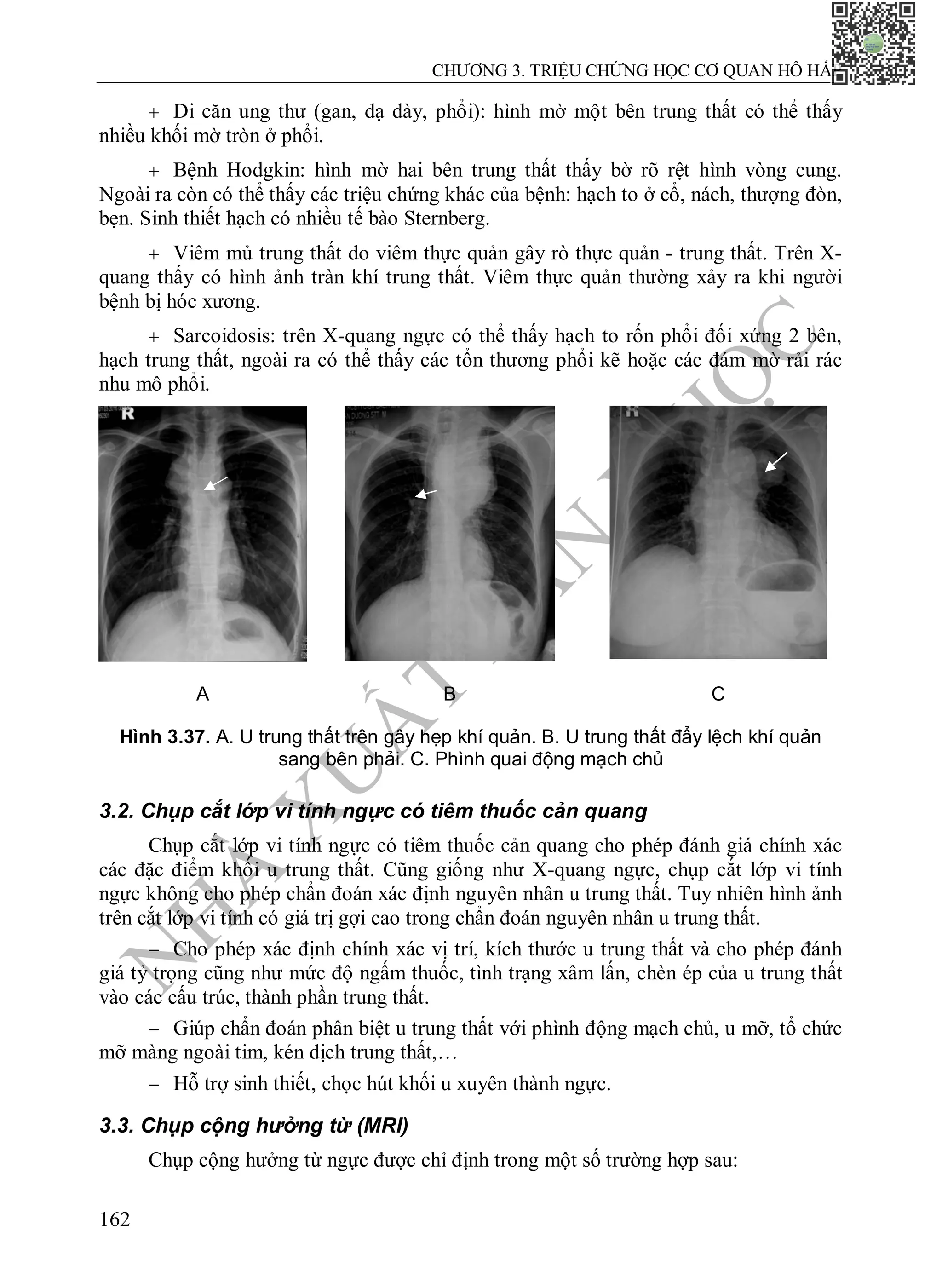 N
H
À
X
U
Ấ
T
B
Ả
N
Y
H
Ọ
C
CHƯƠNG 3. TRIỆU CHỨNG HỌC CƠ QUAN HÔ HẤP
162
 Di căn ung thư (gan, dạ dày, phổi): hình mờ một bên trung thất có thể thấy
nhiều khối mờ tròn ở phổi.
 Bệnh Hodgkin: hình mờ hai bên trung thất thấy bờ rõ rệt hình vòng cung.
Ngoài ra còn có thể thấy các triệu chứng khác của bệnh: hạch to ở cổ, nách, thượng đòn,
bẹn. Sinh thiết hạch có nhiều tế bào Sternberg.
 Viêm mủ trung thất do viêm thực quản gây rò thực quản - trung thất. Trên X-
quang thấy có hình ảnh tràn khí trung thất. Viêm thực quản thường xảy ra khi người
bệnh bị hóc xương.
 Sarcoidosis: trên X-quang ngực có thể thấy hạch to rốn phổi đối xứng 2 bên,
hạch trung thất, ngoài ra có thể thấy các tổn thương phổi kẽ hoặc các đám mờ rải rác
nhu mô phổi.
A B C
Hình 3.37. A. U trung thất trên gây hẹp khí quản. B. U trung thất đẩy lệch khí quản
sang bên phải. C. Phình quai động mạch chủ
3.2. Chụp cắt lớp vi tính ngực có tiêm thuốc cản quang
Chụp cắt lớp vi tính ngực có tiêm thuốc cản quang cho phép đánh giá chính xác
các đặc điểm khối u trung thất. Cũng giống như X-quang ngực, chụp cắt lớp vi tính
ngực không cho phép chẩn đoán xác định nguyên nhân u trung thất. Tuy nhiên hình ảnh
trên cắt lớp vi tính có giá trị gợi cao trong chẩn đoán nguyên nhân u trung thất.
 Cho phép xác định chính xác vị trí, kích thước u trung thất và cho phép đánh
giá tỷ trọng cũng như mức độ ngấm thuốc, tình trạng xâm lấn, chèn ép của u trung thất
vào các cấu trúc, thành phần trung thất.
 Giúp chẩn đoán phân biệt u trung thất với phình động mạch chủ, u mỡ, tổ chức
mỡ màng ngoài tim, kén dịch trung thất,…
 Hỗ trợ sinh thiết, chọc hút khối u xuyên thành ngực.
3.3. Chụp cộng hưởng từ (MRI)
Chụp cộng hưởng từ ngực được chỉ định trong một số trường hợp sau:
 