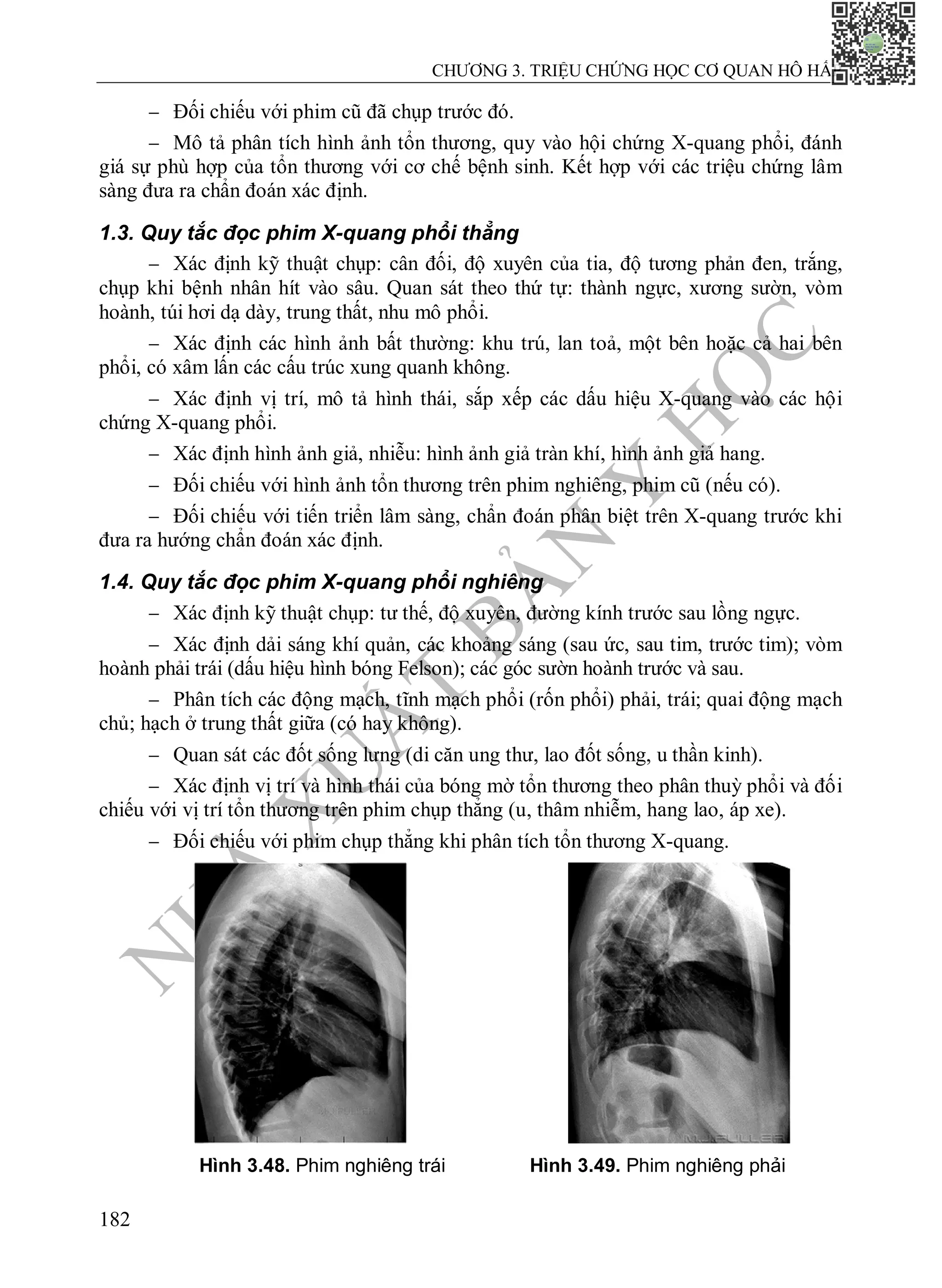 N
H
À
X
U
Ấ
T
B
Ả
N
Y
H
Ọ
C
CHƯƠNG 3. TRIỆU CHỨNG HỌC CƠ QUAN HÔ HẤP
182
 Đối chiếu với phim cũ đã chụp trước đó.
 Mô tả phân tích hình ảnh tổn thương, quy vào hội chứng X-quang phổi, đánh
giá sự phù hợp của tổn thương với cơ chế bệnh sinh. Kết hợp với các triệu chứng lâm
sàng đưa ra chẩn đoán xác định.
1.3. Quy tắc đọc phim X-quang phổi thẳng
 Xác định kỹ thuật chụp: cân đối, độ xuyên của tia, độ tương phản đen, trắng,
chụp khi bệnh nhân hít vào sâu. Quan sát theo thứ tự: thành ngực, xương sườn, vòm
hoành, túi hơi dạ dày, trung thất, nhu mô phổi.
 Xác định các hình ảnh bất thường: khu trú, lan toả, một bên hoặc cả hai bên
phổi, có xâm lấn các cấu trúc xung quanh không.
 Xác định vị trí, mô tả hình thái, sắp xếp các dấu hiệu X-quang vào các hội
chứng X-quang phổi.
 Xác định hình ảnh giả, nhiễu: hình ảnh giả tràn khí, hình ảnh giả hang.
 Đối chiếu với hình ảnh tổn thương trên phim nghiêng, phim cũ (nếu có).
 Đối chiếu với tiến triển lâm sàng, chẩn đoán phân biệt trên X-quang trước khi
đưa ra hướng chẩn đoán xác định.
1.4. Quy tắc đọc phim X-quang phổi nghiêng
 Xác định kỹ thuật chụp: tư thế, độ xuyên, đường kính trước sau lồng ngực.
 Xác định dải sáng khí quản, các khoảng sáng (sau ức, sau tim, trước tim); vòm
hoành phải trái (dấu hiệu hình bóng Felson); các góc sườn hoành trước và sau.
 Phân tích các động mạch, tĩnh mạch phổi (rốn phổi) phải, trái; quai động mạch
chủ; hạch ở trung thất giữa (có hay không).
 Quan sát các đốt sống lưng (di căn ung thư, lao đốt sống, u thần kinh).
 Xác định vị trí và hình thái của bóng mờ tổn thương theo phân thuỳ phổi và đối
chiếu với vị trí tổn thương trên phim chụp thẳng (u, thâm nhiễm, hang lao, áp xe).
 Đối chiếu với phim chụp thẳng khi phân tích tổn thương X-quang.
Hình 3.48. Phim nghiêng trái Hình 3.49. Phim nghiêng phải
 