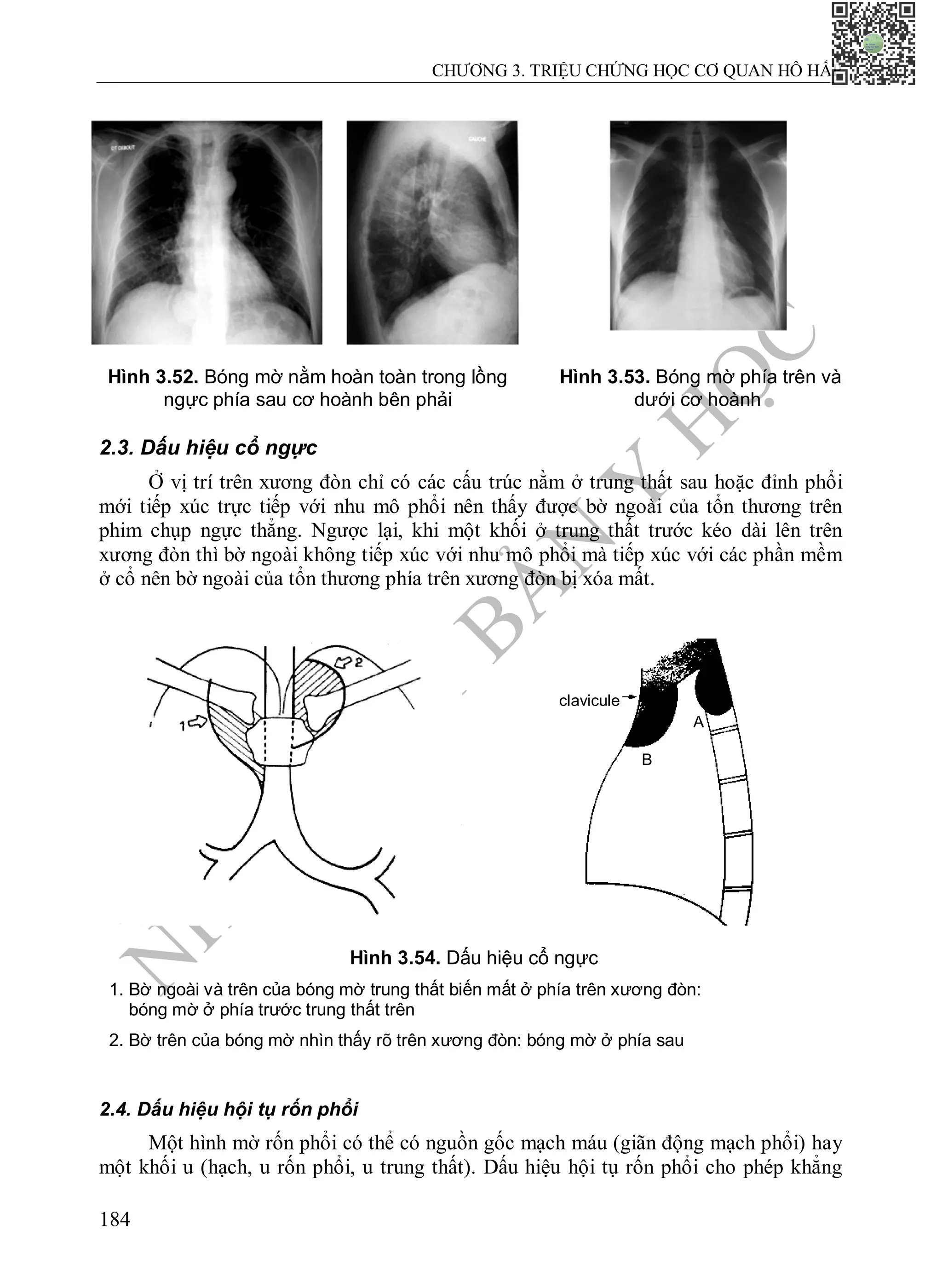 N
H
À
X
U
Ấ
T
B
Ả
N
Y
H
Ọ
C
CHƯƠNG 3. TRIỆU CHỨNG HỌC CƠ QUAN HÔ HẤP
184
2.3. Dấu hiệu cổ ngực
Ở vị trí trên xương đòn chỉ có các cấu trúc nằm ở trung thất sau hoặc đỉnh phổi
mới tiếp xúc trực tiếp với nhu mô phổi nên thấy được bờ ngoài của tổn thương trên
phim chụp ngực thẳng. Ngược lại, khi một khối ở trung thất trước kéo dài lên trên
xương đòn thì bờ ngoài không tiếp xúc với nhu mô phổi mà tiếp xúc với các phần mềm
ở cổ nên bờ ngoài của tổn thương phía trên xương đòn bị xóa mất.
2.4. Dấu hiệu hội tụ rốn phổi
Một hình mờ rốn phổi có thể có nguồn gốc mạch máu (giãn động mạch phổi) hay
một khối u (hạch, u rốn phổi, u trung thất). Dấu hiệu hội tụ rốn phổi cho phép khẳng
Hình 3.52. Bóng mờ nằm hoàn toàn trong lồng
ngực phía sau cơ hoành bên phải
Hình 3.53. Bóng mờ phía trên và
dưới cơ hoành
Hình 3.54. Dấu hiệu cổ ngực
1. Bờ ngoài và trên của bóng mờ trung thất biến mất ở phía trên xương đòn:
bóng mờ ở phía trước trung thất trên
2. Bờ trên của bóng mờ nhìn thấy rõ trên xương đòn: bóng mờ ở phía sau
clavicule
B
A
 