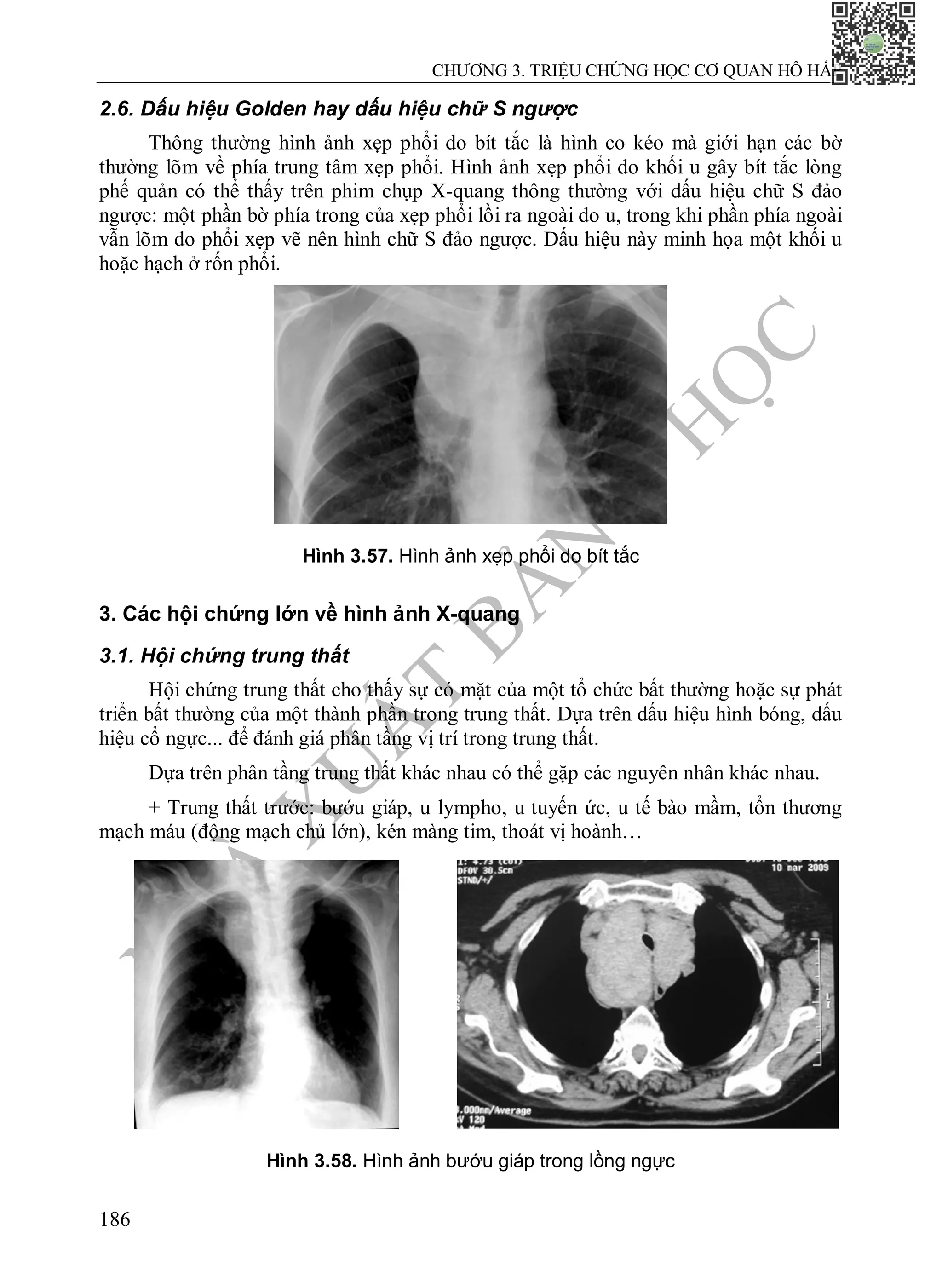 N
H
À
X
U
Ấ
T
B
Ả
N
Y
H
Ọ
C
CHƯƠNG 3. TRIỆU CHỨNG HỌC CƠ QUAN HÔ HẤP
186
2.6. Dấu hiệu Golden hay dấu hiệu chữ S ngược
Thông thường hình ảnh xẹp phổi do bít tắc là hình co kéo mà giới hạn các bờ
thường lõm về phía trung tâm xẹp phổi. Hình ảnh xẹp phổi do khối u gây bít tắc lòng
phế quản có thể thấy trên phim chụp X-quang thông thường với dấu hiệu chữ S đảo
ngược: một phần bờ phía trong của xẹp phổi lồi ra ngoài do u, trong khi phần phía ngoài
vẫn lõm do phổi xẹp vẽ nên hình chữ S đảo ngược. Dấu hiệu này minh họa một khối u
hoặc hạch ở rốn phổi.
Hình 3.57. Hình ảnh xẹp phổi do bít tắc
3. Các hội chứng lớn về hình ảnh X-quang
3.1. Hội chứng trung thất
Hội chứng trung thất cho thấy sự có mặt của một tổ chức bất thường hoặc sự phát
triển bất thường của một thành phần trong trung thất. Dựa trên dấu hiệu hình bóng, dấu
hiệu cổ ngực... để đánh giá phân tầng vị trí trong trung thất.
Dựa trên phân tầng trung thất khác nhau có thể gặp các nguyên nhân khác nhau.
+ Trung thất trước: bướu giáp, u lympho, u tuyến ức, u tế bào mầm, tổn thương
mạch máu (động mạch chủ lớn), kén màng tim, thoát vị hoành…
Hình 3.58. Hình ảnh bướu giáp trong lồng ngực
 