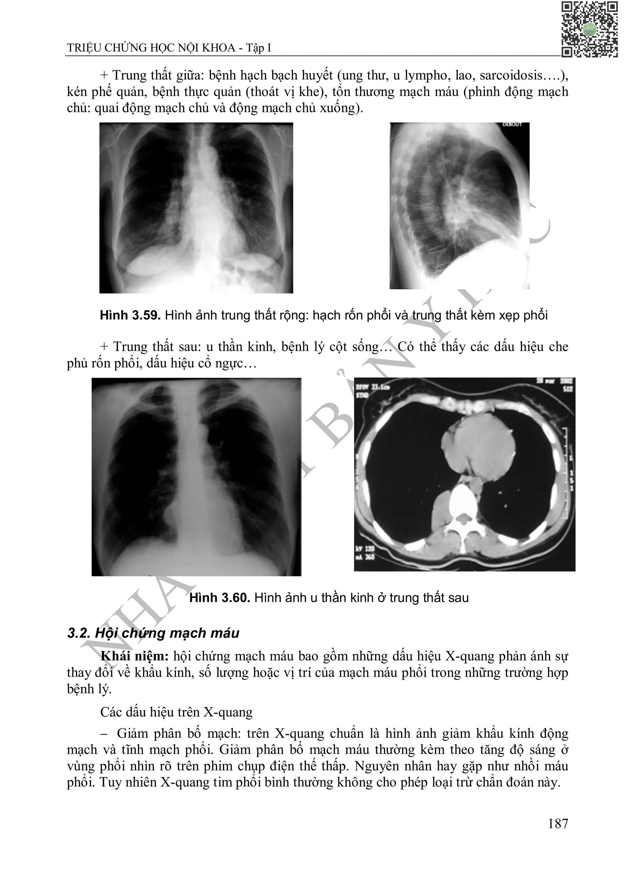 N
H
À
X
U
Ấ
T
B
Ả
N
Y
H
Ọ
C
TRIỆU CHỨNG HỌC NỘI KHOA - Tập I
187
+ Trung thất giữa: bệnh hạch bạch huyết (ung thư, u lympho, lao, sarcoidosis….),
kén phế quản, bệnh thực quản (thoát vị khe), tổn thương mạch máu (phình động mạch
chủ: quai động mạch chủ và động mạch chủ xuống).
Hình 3.59. Hình ảnh trung thất rộng: hạch rốn phổi và trung thất kèm xẹp phổi
+ Trung thất sau: u thần kinh, bệnh lý cột sống… Có thể thấy các dấu hiệu che
phủ rốn phổi, dấu hiệu cổ ngực…
Hình 3.60. Hình ảnh u thần kinh ở trung thất sau
3.2. Hội chứng mạch máu
Khái niệm: hội chứng mạch máu bao gồm những dấu hiệu X-quang phản ánh sự
thay đổi về khẩu kính, số lượng hoặc vị trí của mạch máu phổi trong những trường hợp
bệnh lý.
Các dấu hiệu trên X-quang
 Giảm phân bố mạch: trên X-quang chuẩn là hình ảnh giảm khẩu kính động
mạch và tĩnh mạch phổi. Giảm phân bố mạch máu thường kèm theo tăng độ sáng ở
vùng phổi nhìn rõ trên phim chụp điện thế thấp. Nguyên nhân hay gặp như nhồi máu
phổi. Tuy nhiên X-quang tim phổi bình thường không cho phép loại trừ chẩn đoán này.
 