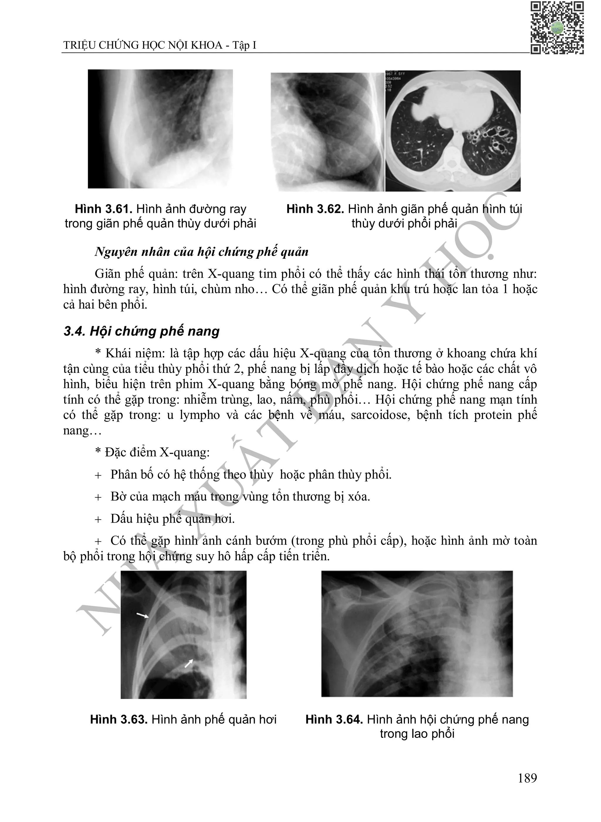 N
H
À
X
U
Ấ
T
B
Ả
N
Y
H
Ọ
C
TRIỆU CHỨNG HỌC NỘI KHOA - Tập I
189
Hình 3.61. Hình ảnh đường ray
trong giãn phế quản thùy dưới phải
Hình 3.62. Hình ảnh giãn phế quản hình túi
thùy dưới phổi phải
Nguyên nhân của hội chứng phế quản
Giãn phế quản: trên X-quang tim phổi có thể thấy các hình thái tổn thương như:
hình đường ray, hình túi, chùm nho… Có thể giãn phế quản khu trú hoặc lan tỏa 1 hoặc
cả hai bên phổi.
3.4. Hội chứng phế nang
* Khái niệm: là tập hợp các dấu hiệu X-quang của tổn thương ở khoang chứa khí
tận cùng của tiểu thùy phổi thứ 2, phế nang bị lấp đầy dịch hoặc tế bào hoặc các chất vô
hình, biểu hiện trên phim X-quang bằng bóng mờ phế nang. Hội chứng phế nang cấp
tính có thể gặp trong: nhiễm trùng, lao, nấm, phù phổi… Hội chứng phế nang mạn tính
có thể gặp trong: u lympho và các bệnh về máu, sarcoidose, bệnh tích protein phế
nang…
* Đặc điểm X-quang:
 Phân bố có hệ thống theo thùy hoặc phân thùy phổi.
 Bờ của mạch máu trong vùng tổn thương bị xóa.
 Dấu hiệu phế quản hơi.
 Có thể gặp hình ảnh cánh bướm (trong phù phổi cấp), hoặc hình ảnh mờ toàn
bộ phổi trong hội chứng suy hô hấp cấp tiến triển.
Hình 3.63. Hình ảnh phế quản hơi Hình 3.64. Hình ảnh hội chứng phế nang
trong lao phổi
 