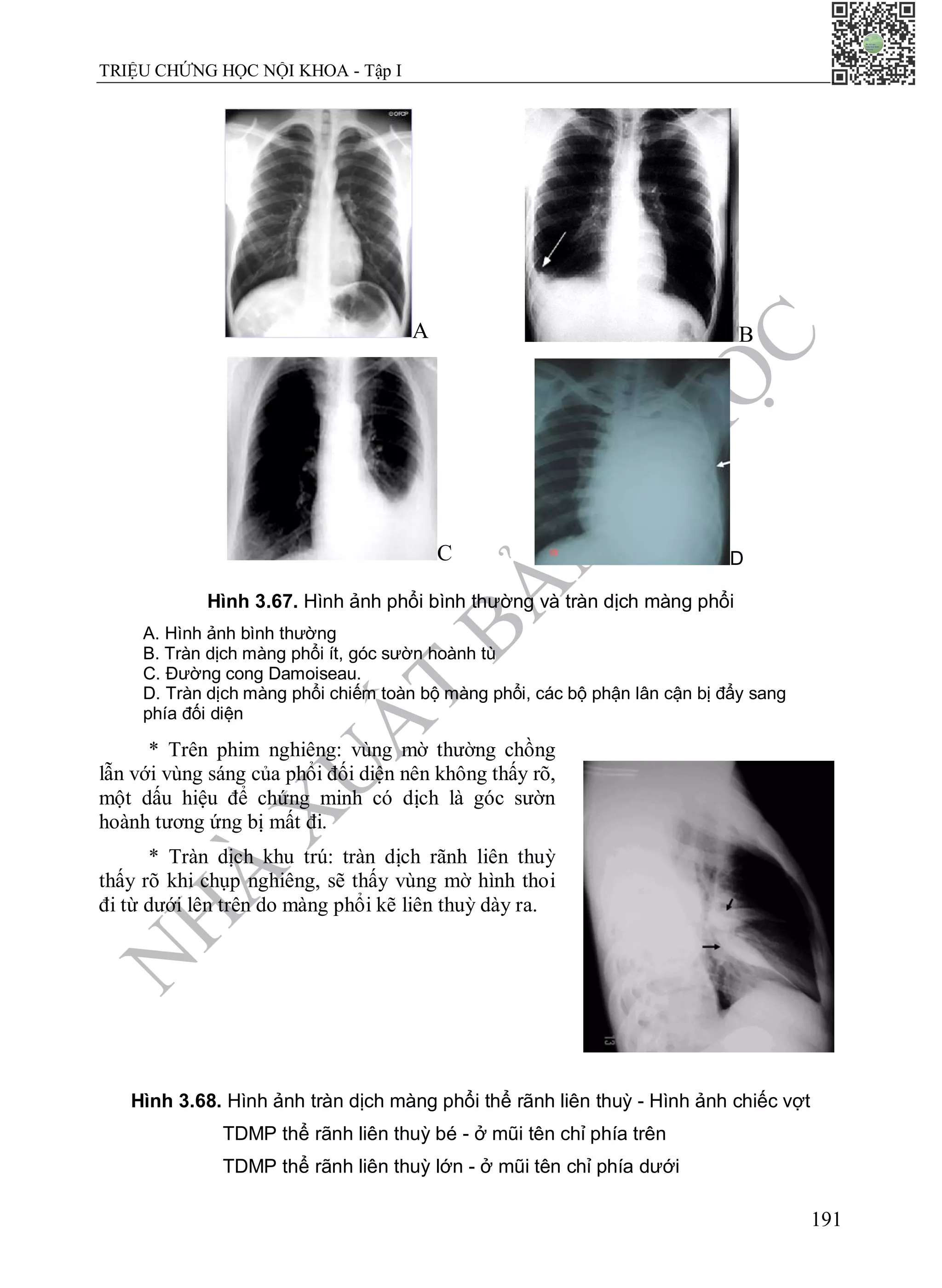 N
H
À
X
U
Ấ
T
B
Ả
N
Y
H
Ọ
C
TRIỆU CHỨNG HỌC NỘI KHOA - Tập I
191
A B
C D
Hình 3.67. Hình ảnh phổi bình thường và tràn dịch màng phổi
A. Hình ảnh bình thường
B. Tràn dịch màng phổi ít, góc sườn hoành tù
C. Đường cong Damoiseau.
D. Tràn dịch màng phổi chiếm toàn bộ màng phổi, các bộ phận lân cận bị đẩy sang
phía đối diện
* Trên phim nghiêng: vùng mờ thường chồng
lẫn với vùng sáng của phổi đối diện nên không thấy rõ,
một dấu hiệu để chứng minh có dịch là góc sườn
hoành tương ứng bị mất đi.
* Tràn dịch khu trú: tràn dịch rãnh liên thuỳ
thấy rõ khi chụp nghiêng, sẽ thấy vùng mờ hình thoi
đi từ dưới lên trên do màng phổi kẽ liên thuỳ dày ra.
Hình 3.68. Hình ảnh tràn dịch màng phổi thể rãnh liên thuỳ - Hình ảnh chiếc vợt
TDMP thể rãnh liên thuỳ bé - ở mũi tên chỉ phía trên
TDMP thể rãnh liên thuỳ lớn - ở mũi tên chỉ phía dưới
 
