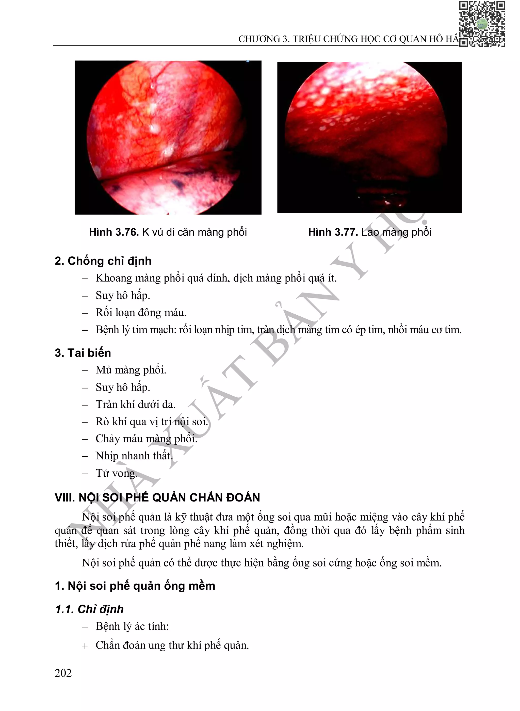N
H
À
X
U
Ấ
T
B
Ả
N
Y
H
Ọ
C
CHƯƠNG 3. TRIỆU CHỨNG HỌC CƠ QUAN HÔ HẤP
202
Hình 3.76. K vú di căn màng phổi Hình 3.77. Lao màng phổi
2. Chống chỉ định
 Khoang màng phổi quá dính, dịch màng phổi quá ít.
 Suy hô hấp.
 Rối loạn đông máu.
 Bệnh lý tim mạch: rối loạn nhịp tim, tràn dịch màng tim có ép tim, nhồi máu cơ tim.
3. Tai biến
 Mủ màng phổi.
 Suy hô hấp.
 Tràn khí dưới da.
 Rò khí qua vị trí nội soi.
 Chảy máu màng phổi.
 Nhịp nhanh thất.
 Tử vong.
VIII. NỘI SOI PHẾ QUẢN CHẨN ĐOÁN
Nội soi phế quản là kỹ thuật đưa một ống soi qua mũi hoặc miệng vào cây khí phế
quản để quan sát trong lòng cây khí phế quản, đồng thời qua đó lấy bệnh phẩm sinh
thiết, lấy dịch rửa phế quản phế nang làm xét nghiệm.
Nội soi phế quản có thể được thực hiện bằng ống soi cứng hoặc ống soi mềm.
1. Nội soi phế quản ống mềm
1.1. Chỉ định
 Bệnh lý ác tính:
 Chẩn đoán ung thư khí phế quản.
 