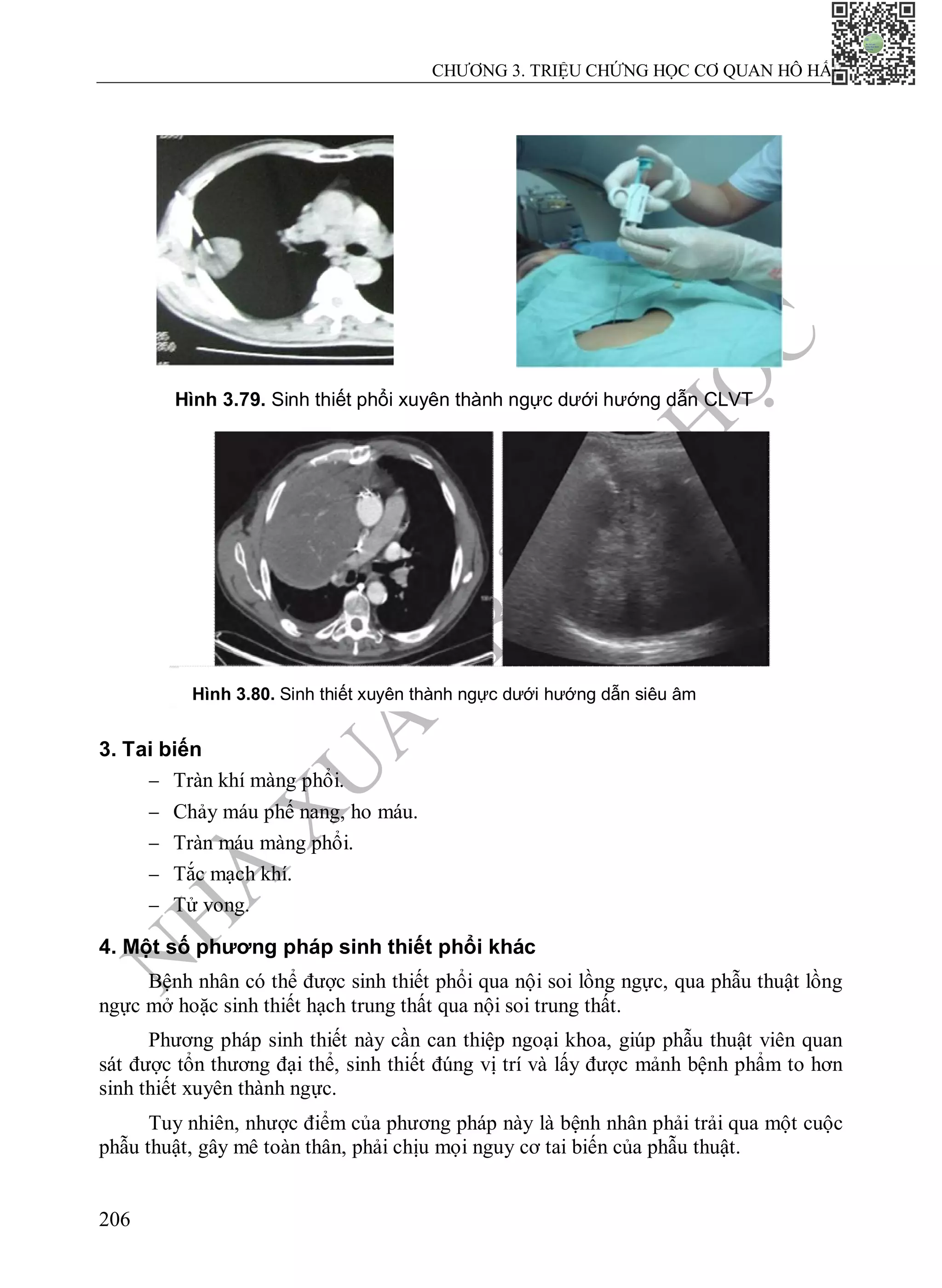 N
H
À
X
U
Ấ
T
B
Ả
N
Y
H
Ọ
C
CHƯƠNG 3. TRIỆU CHỨNG HỌC CƠ QUAN HÔ HẤP
206
Hình 3.79. Sinh thiết phổi xuyên thành ngực dưới hướng dẫn CLVT
3. Tai biến
 Tràn khí màng phổi.
 Chảy máu phế nang, ho máu.
 Tràn máu màng phổi.
 Tắc mạch khí.
 Tử vong.
4. Một số phương pháp sinh thiết phổi khác
Bệnh nhân có thể được sinh thiết phổi qua nội soi lồng ngực, qua phẫu thuật lồng
ngực mở hoặc sinh thiết hạch trung thất qua nội soi trung thất.
Phương pháp sinh thiết này cần can thiệp ngoại khoa, giúp phẫu thuật viên quan
sát được tổn thương đại thể, sinh thiết đúng vị trí và lấy được mảnh bệnh phẩm to hơn
sinh thiết xuyên thành ngực.
Tuy nhiên, nhược điểm của phương pháp này là bệnh nhân phải trải qua một cuộc
phẫu thuật, gây mê toàn thân, phải chịu mọi nguy cơ tai biến của phẫu thuật.
Hình 3.80. Sinh thiết xuyên thành ngực dưới hướng dẫn siêu âm
 