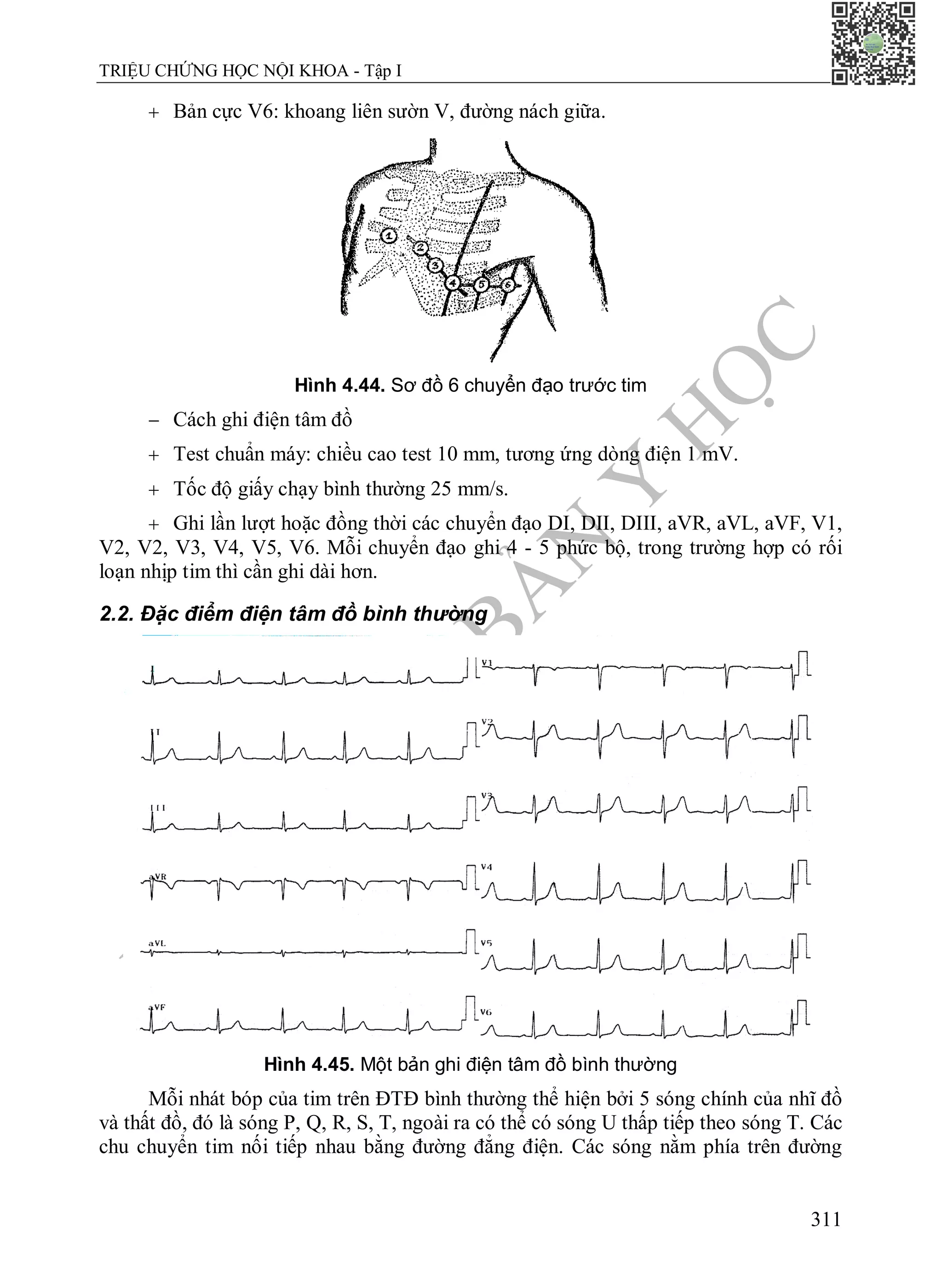 N
H
À
X
U
Ấ
T
B
Ả
N
Y
H
Ọ
C
TRIỆU CHỨNG HỌC NỘI KHOA - Tập I
311
 Bản cực V6: khoang liên sườn V, đường nách giữa.
Hình 4.44. Sơ đồ 6 chuyển đạo trước tim
 Cách ghi điện tâm đồ
 Test chuẩn máy: chiều cao test 10 mm, tương ứng dòng điện 1 mV.
 Tốc độ giấy chạy bình thường 25 mm/s.
 Ghi lần lượt hoặc đồng thời các chuyển đạo DI, DII, DIII, aVR, aVL, aVF, V1,
V2, V2, V3, V4, V5, V6. Mỗi chuyển đạo ghi 4 - 5 phức bộ, trong trường hợp có rối
loạn nhịp tim thì cần ghi dài hơn.
2.2. Đặc điểm điện tâm đồ bình thường
Hình 4.45. Một bản ghi điện tâm đồ bình thường
Mỗi nhát bóp của tim trên ĐTĐ bình thường thể hiện bởi 5 sóng chính của nhĩ đồ
và thất đồ, đó là sóng P, Q, R, S, T, ngoài ra có thể có sóng U thấp tiếp theo sóng T. Các
chu chuyển tim nối tiếp nhau bằng đường đẳng điện. Các sóng nằm phía trên đường
 