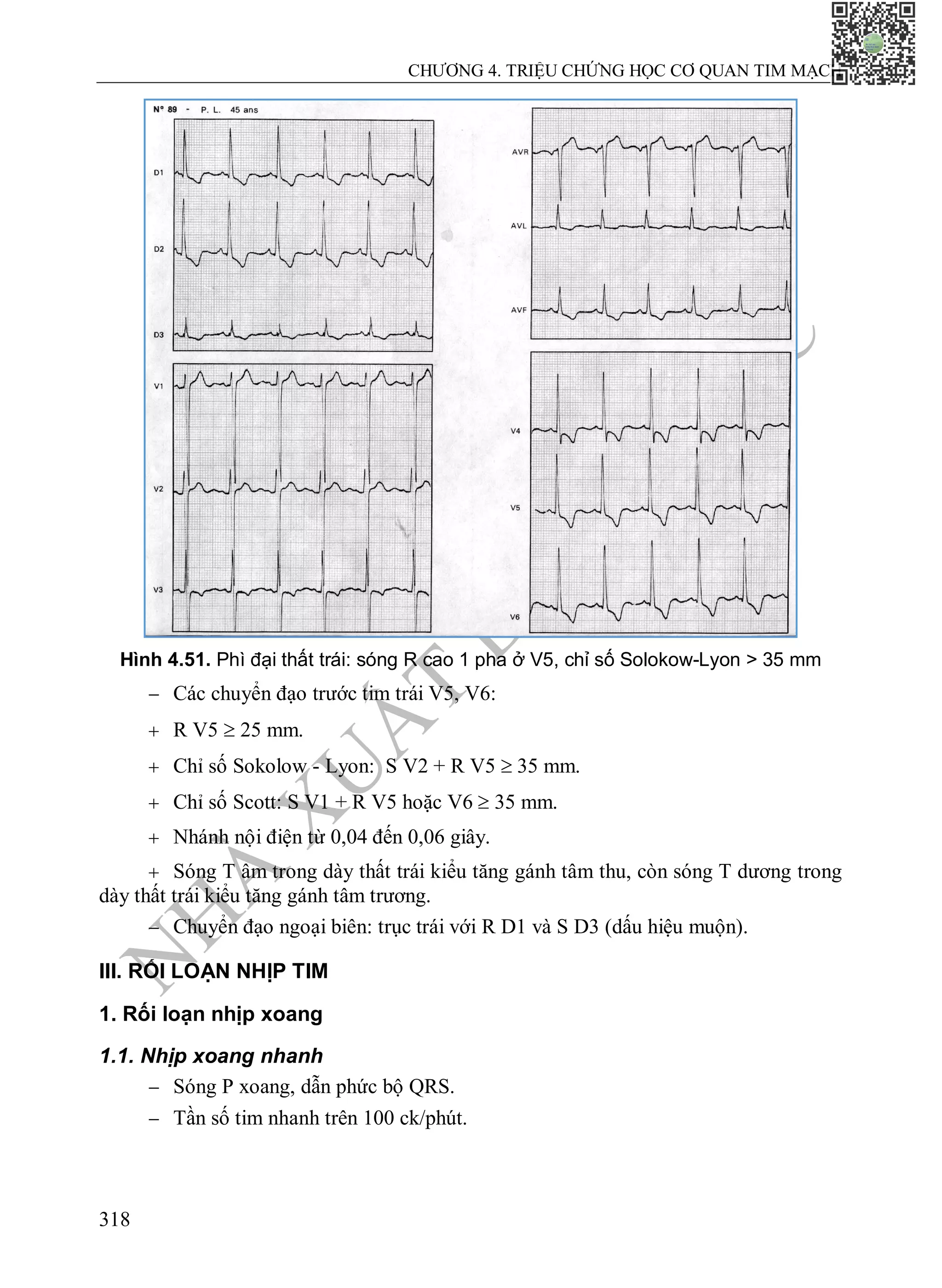 N
H
À
X
U
Ấ
T
B
Ả
N
Y
H
Ọ
C
CHƯƠNG 4. TRIỆU CHỨNG HỌC CƠ QUAN TIM MẠCH
318
Hình 4.51. Phì đại thất trái: sóng R cao 1 pha ở V5, chỉ số Solokow-Lyon > 35 mm
 Các chuyển đạo trước tim trái V5, V6:
 R V5  25 mm.
 Chỉ số Sokolow - Lyon: S V2 + R V5  35 mm.
 Chỉ số Scott: S V1 + R V5 hoặc V6  35 mm.
 Nhánh nội điện từ 0,04 đến 0,06 giây.
 Sóng T âm trong dày thất trái kiểu tăng gánh tâm thu, còn sóng T dương trong
dày thất trái kiểu tăng gánh tâm trương.
 Chuyển đạo ngoại biên: trục trái với R D1 và S D3 (dấu hiệu muộn).
III. RỐI LOẠN NHỊP TIM
1. Rối loạn nhịp xoang
1.1. Nhịp xoang nhanh
 Sóng P xoang, dẫn phức bộ QRS.
 Tần số tim nhanh trên 100 ck/phút.
 