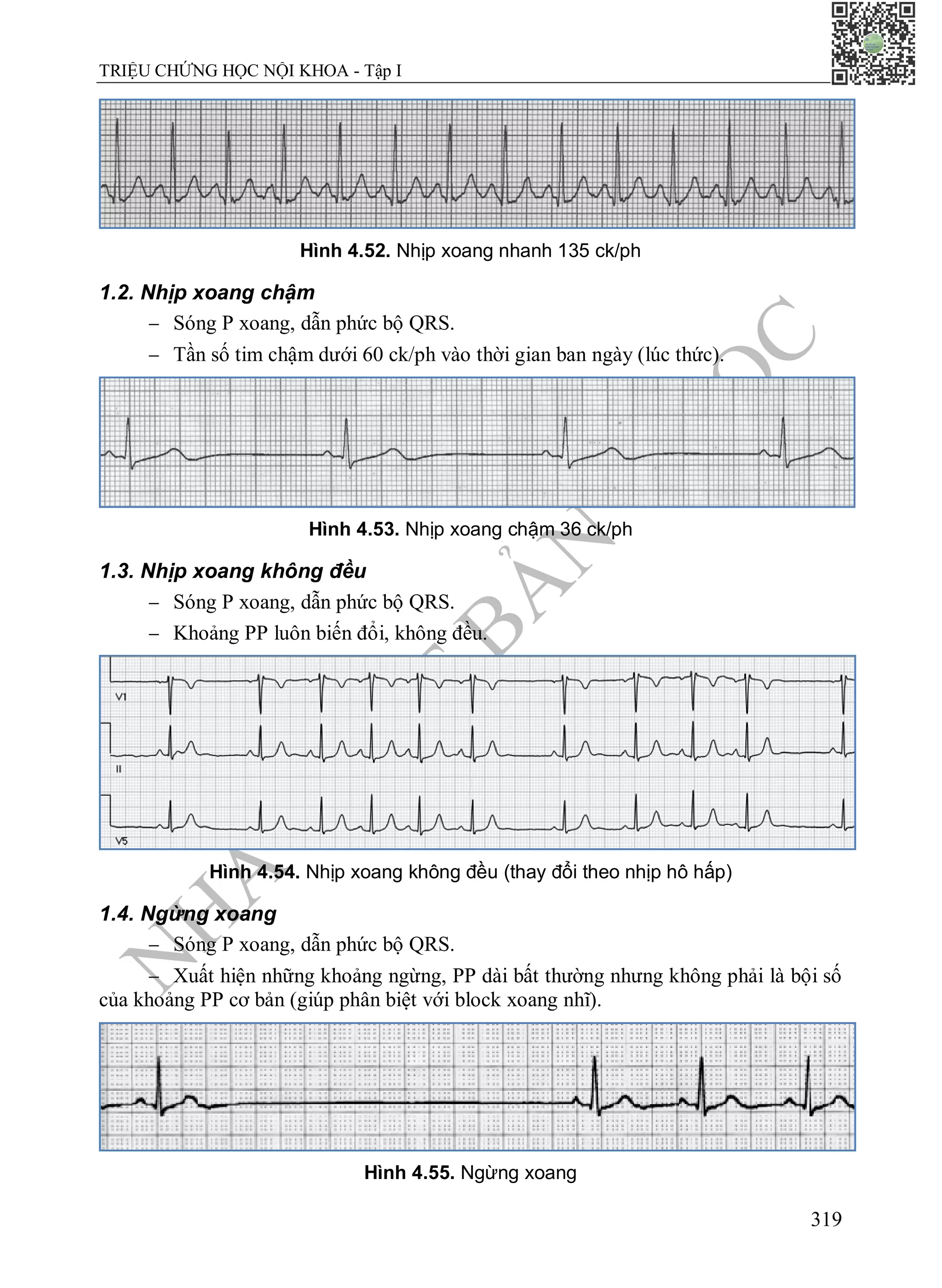 N
H
À
X
U
Ấ
T
B
Ả
N
Y
H
Ọ
C
TRIỆU CHỨNG HỌC NỘI KHOA - Tập I
319
Hình 4.52. Nhịp xoang nhanh 135 ck/ph
1.2. Nhịp xoang chậm
 Sóng P xoang, dẫn phức bộ QRS.
 Tần số tim chậm dưới 60 ck/ph vào thời gian ban ngày (lúc thức).
Hình 4.53. Nhịp xoang chậm 36 ck/ph
1.3. Nhịp xoang không đều
 Sóng P xoang, dẫn phức bộ QRS.
 Khoảng PP luôn biến đổi, không đều.
Hình 4.54. Nhịp xoang không đều (thay đổi theo nhịp hô hấp)
1.4. Ngừng xoang
 Sóng P xoang, dẫn phức bộ QRS.
 Xuất hiện những khoảng ngừng, PP dài bất thường nhưng không phải là bội số
của khoảng PP cơ bản (giúp phân biệt với block xoang nhĩ).
Hình 4.55. Ngừng xoang
 