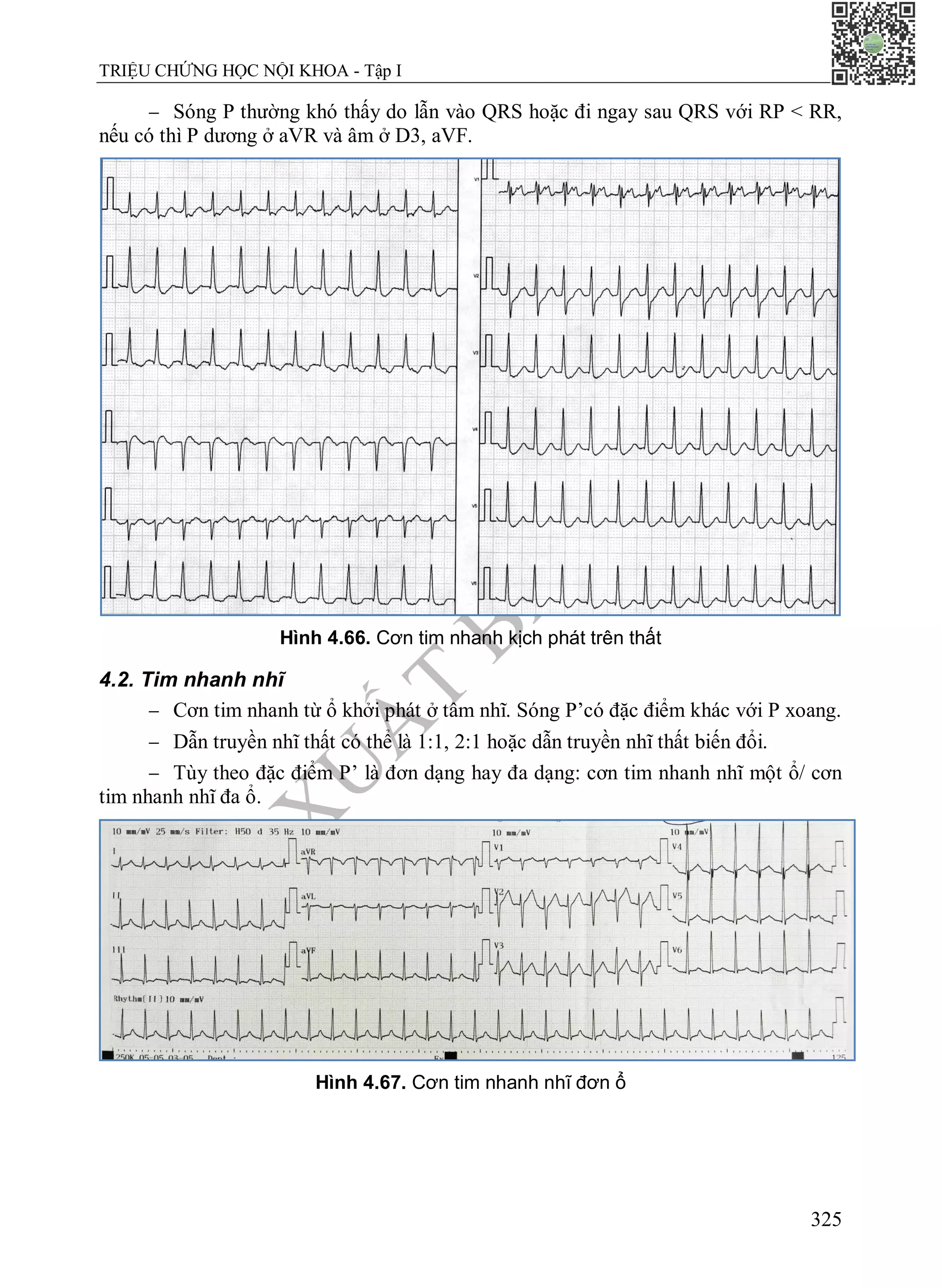 N
H
À
X
U
Ấ
T
B
Ả
N
Y
H
Ọ
C
TRIỆU CHỨNG HỌC NỘI KHOA - Tập I
325
 Sóng P thường khó thấy do lẫn vào QRS hoặc đi ngay sau QRS với RP < RR,
nếu có thì P dương ở aVR và âm ở D3, aVF.
Hình 4.66. Cơn tim nhanh kịch phát trên thất
4.2. Tim nhanh nhĩ
 Cơn tim nhanh từ ổ khởi phát ở tâm nhĩ. Sóng P’có đặc điểm khác với P xoang.
 Dẫn truyền nhĩ thất có thể là 1:1, 2:1 hoặc dẫn truyền nhĩ thất biến đổi.
 Tùy theo đặc điểm P’ là đơn dạng hay đa dạng: cơn tim nhanh nhĩ một ổ/ cơn
tim nhanh nhĩ đa ổ.
Hình 4.67. Cơn tim nhanh nhĩ đơn ổ
 