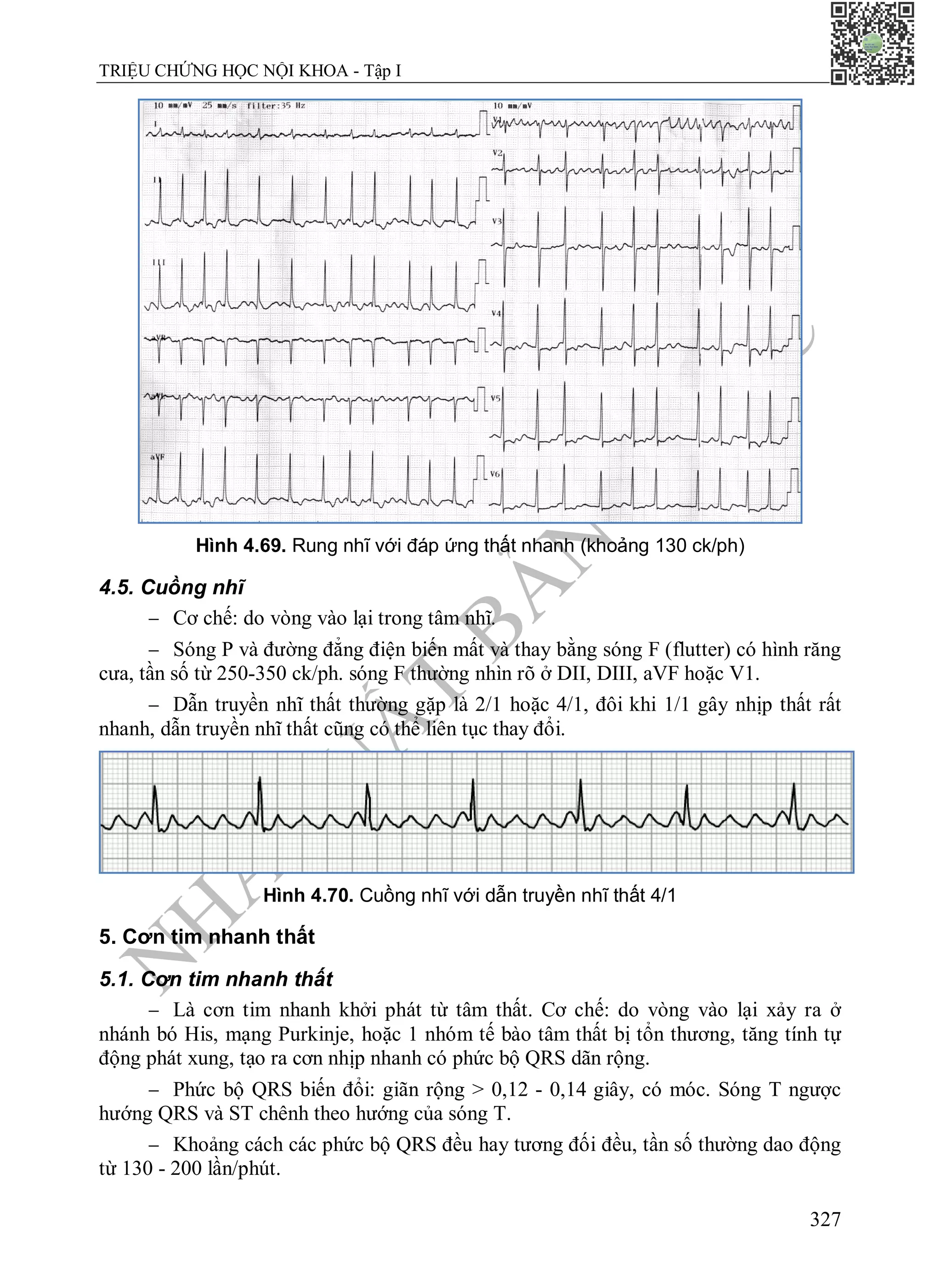 N
H
À
X
U
Ấ
T
B
Ả
N
Y
H
Ọ
C
TRIỆU CHỨNG HỌC NỘI KHOA - Tập I
327
Hình 4.69. Rung nhĩ với đáp ứng thất nhanh (khoảng 130 ck/ph)
4.5. Cuồng nhĩ
 Cơ chế: do vòng vào lại trong tâm nhĩ.
 Sóng P và đường đẳng điện biến mất và thay bằng sóng F (flutter) có hình răng
cưa, tần số từ 250-350 ck/ph. sóng F thường nhìn rõ ở DII, DIII, aVF hoặc V1.
 Dẫn truyền nhĩ thất thường gặp là 2/1 hoặc 4/1, đôi khi 1/1 gây nhịp thất rất
nhanh, dẫn truyền nhĩ thất cũng có thể liên tục thay đổi.
Hình 4.70. Cuồng nhĩ với dẫn truyền nhĩ thất 4/1
5. Cơn tim nhanh thất
5.1. Cơn tim nhanh thất
 Là cơn tim nhanh khởi phát từ tâm thất. Cơ chế: do vòng vào lại xảy ra ở
nhánh bó His, mạng Purkinje, hoặc 1 nhóm tế bào tâm thất bị tổn thương, tăng tính tự
động phát xung, tạo ra cơn nhịp nhanh có phức bộ QRS dãn rộng.
 Phức bộ QRS biến đổi: giãn rộng > 0,12 - 0,14 giây, có móc. Sóng T ngược
hướng QRS và ST chênh theo hướng của sóng T.
 Khoảng cách các phức bộ QRS đều hay tương đối đều, tần số thường dao động
từ 130 - 200 lần/phút.
 