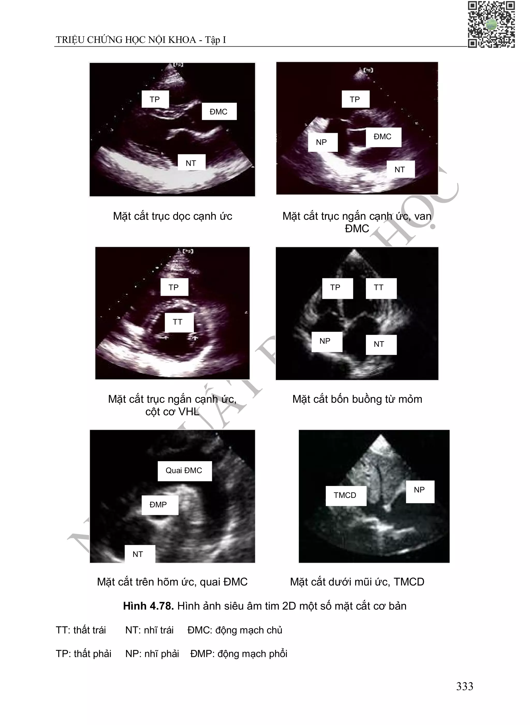 N
H
À
X
U
Ấ
T
B
Ả
N
Y
H
Ọ
C
TRIỆU CHỨNG HỌC NỘI KHOA - Tập I
333
Mặt cắt trục dọc cạnh ức Mặt cắt trục ngắn cạnh ức, van
ĐMC
Mặt cắt trục ngắn cạnh ức,
cột cơ VHL
Mặt cắt bốn buồng từ mỏm
Mặt cắt trên hõm ức, quai ĐMC Mặt cắt dưới mũi ức, TMCD
Hình 4.78. Hình ảnh siêu âm tim 2D một số mặt cắt cơ bản
TT: thất trái NT: nhĩ trái ĐMC: động mạch chủ
TP: thất phải NP: nhĩ phải ĐMP: động mạch phổi
TP
ĐMC
NT
TP
NP
ĐMC
NT
TP
TT
TP TT
NP NT
Quai ĐMC
ĐMP
NT
TMCD
NP
 
