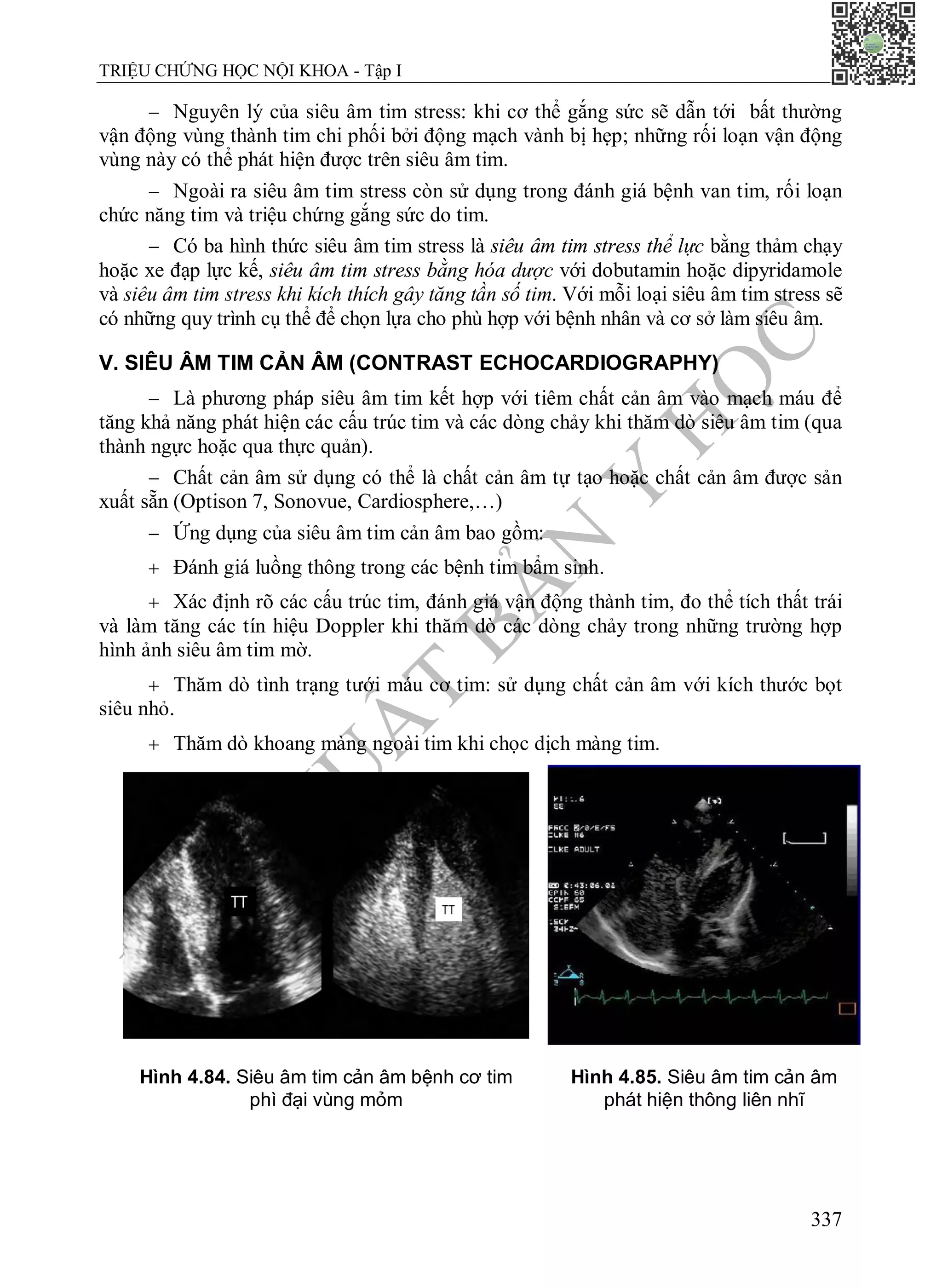 N
H
À
X
U
Ấ
T
B
Ả
N
Y
H
Ọ
C
TRIỆU CHỨNG HỌC NỘI KHOA - Tập I
337
 Nguyên lý của siêu âm tim stress: khi cơ thể gắng sức sẽ dẫn tới bất thường
vận động vùng thành tim chi phối bởi động mạch vành bị hẹp; những rối loạn vận động
vùng này có thể phát hiện được trên siêu âm tim.
 Ngoài ra siêu âm tim stress còn sử dụng trong đánh giá bệnh van tim, rối loạn
chức năng tim và triệu chứng gắng sức do tim.
 Có ba hình thức siêu âm tim stress là siêu âm tim stress thể lực bằng thảm chạy
hoặc xe đạp lực kế, siêu âm tim stress bằng hóa dược với dobutamin hoặc dipyridamole
và siêu âm tim stress khi kích thích gây tăng tần số tim. Với mỗi loại siêu âm tim stress sẽ
có những quy trình cụ thể để chọn lựa cho phù hợp với bệnh nhân và cơ sở làm siêu âm.
V. SIÊU ÂM TIM CẢN ÂM (CONTRAST ECHOCARDIOGRAPHY)
 Là phương pháp siêu âm tim kết hợp với tiêm chất cản âm vào mạch máu để
tăng khả năng phát hiện các cấu trúc tim và các dòng chảy khi thăm dò siêu âm tim (qua
thành ngực hoặc qua thực quản).
 Chất cản âm sử dụng có thể là chất cản âm tự tạo hoặc chất cản âm được sản
xuất sẵn (Optison 7, Sonovue, Cardiosphere,…)
 Ứng dụng của siêu âm tim cản âm bao gồm:
 Đánh giá luồng thông trong các bệnh tim bẩm sinh.
 Xác định rõ các cấu trúc tim, đánh giá vận động thành tim, đo thể tích thất trái
và làm tăng các tín hiệu Doppler khi thăm dò các dòng chảy trong những trường hợp
hình ảnh siêu âm tim mờ.
 Thăm dò tình trạng tưới máu cơ tim: sử dụng chất cản âm với kích thước bọt
siêu nhỏ.
 Thăm dò khoang màng ngoài tim khi chọc dịch màng tim.
Hình 4.84. Siêu âm tim cản âm bệnh cơ tim
phì đại vùng mỏm
Hình 4.85. Siêu âm tim cản âm
phát hiện thông liên nhĩ
 