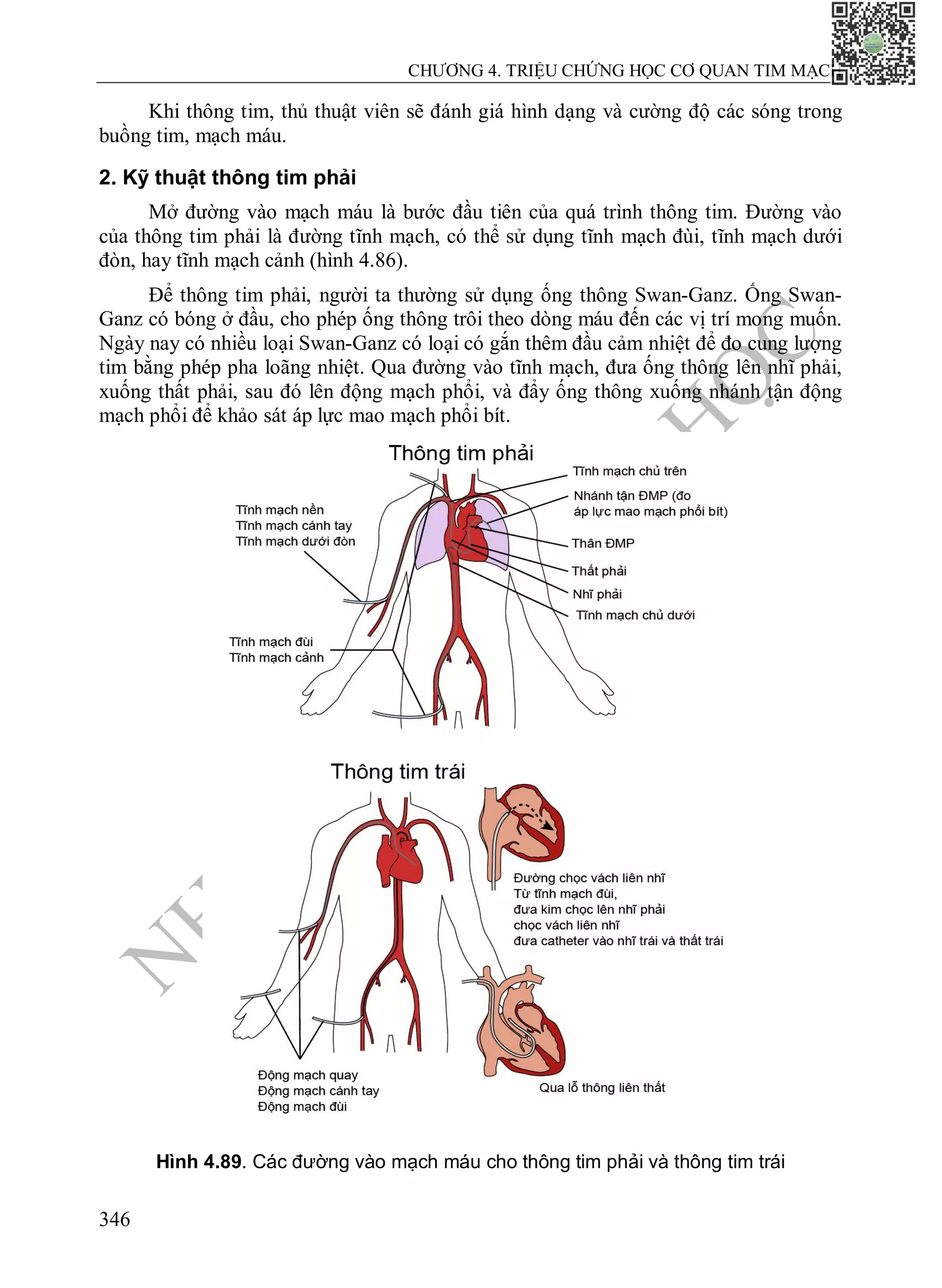 N
H
À
X
U
Ấ
T
B
Ả
N
Y
H
Ọ
C
CHƯƠNG 4. TRIỆU CHỨNG HỌC CƠ QUAN TIM MẠCH
346
Khi thông tim, thủ thuật viên sẽ đánh giá hình dạng và cường độ các sóng trong
buồng tim, mạch máu.
2. Kỹ thuật thông tim phải
Mở đường vào mạch máu là bước đầu tiên của quá trình thông tim. Đường vào
của thông tim phải là đường tĩnh mạch, có thể sử dụng tĩnh mạch đùi, tĩnh mạch dưới
đòn, hay tĩnh mạch cảnh (hình 4.86).
Để thông tim phải, người ta thường sử dụng ống thông Swan-Ganz. Ống Swan-
Ganz có bóng ở đầu, cho phép ống thông trôi theo dòng máu đến các vị trí mong muốn.
Ngày nay có nhiều loại Swan-Ganz có loại có gắn thêm đầu cảm nhiệt để đo cung lượng
tim bằng phép pha loãng nhiệt. Qua đường vào tĩnh mạch, đưa ống thông lên nhĩ phải,
xuống thất phải, sau đó lên động mạch phổi, và đẩy ống thông xuống nhánh tận động
mạch phổi để khảo sát áp lực mao mạch phổi bít.
Hình 4.89. Các đường vào mạch máu cho thông tim phải và thông tim trái
 