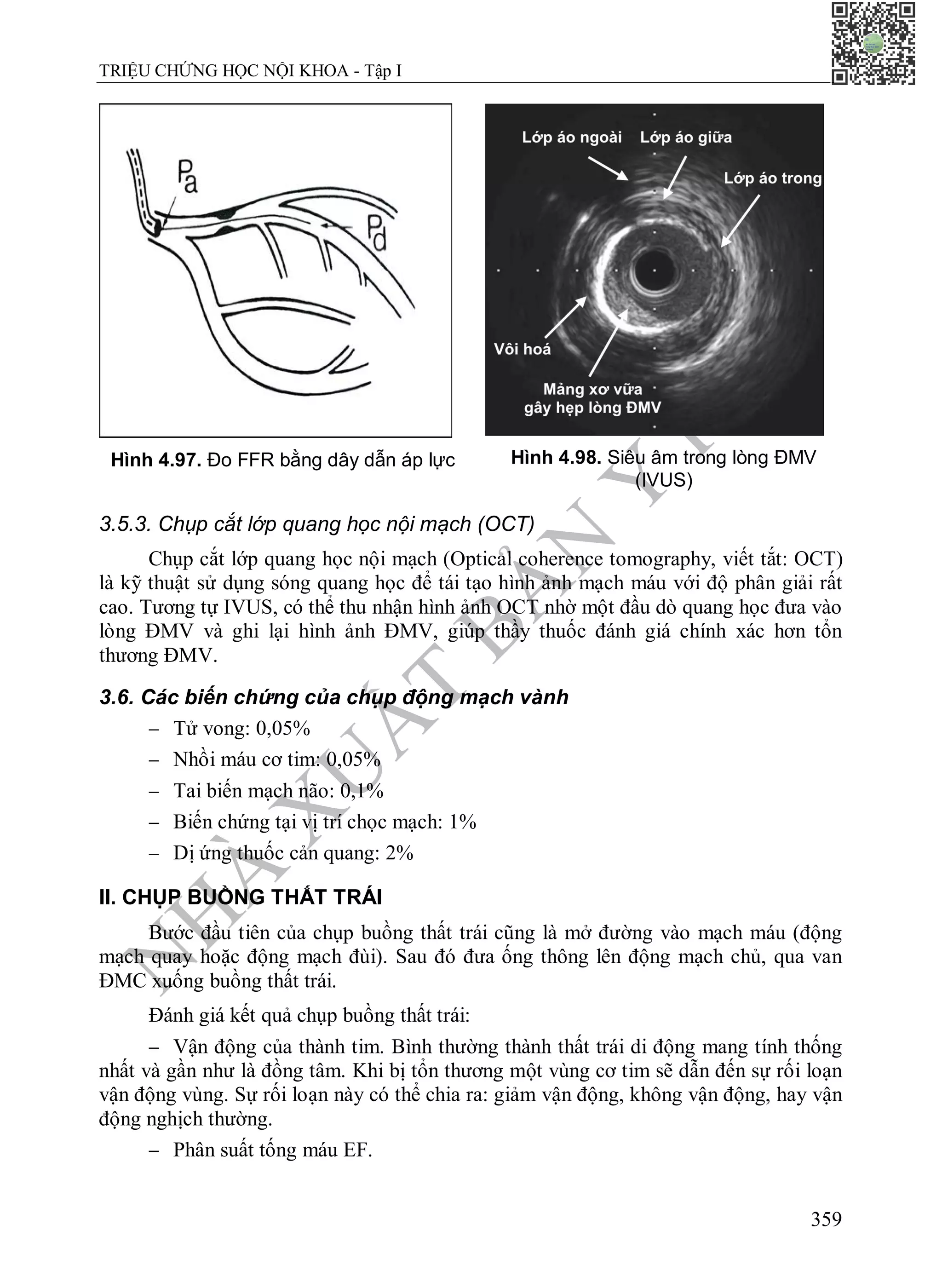 N
H
À
X
U
Ấ
T
B
Ả
N
Y
H
Ọ
C
TRIỆU CHỨNG HỌC NỘI KHOA - Tập I
359
Hình 4.97. Đo FFR bằng dây dẫn áp lực Hình 4.98. Siêu âm trong lòng ĐMV
(IVUS)
3.5.3. Chụp cắt lớp quang học nội mạch (OCT)
Chụp cắt lớp quang học nội mạch (Optical coherence tomography, viết tắt: OCT)
là kỹ thuật sử dụng sóng quang học để tái tạo hình ảnh mạch máu với độ phân giải rất
cao. Tương tự IVUS, có thể thu nhận hình ảnh OCT nhờ một đầu dò quang học đưa vào
lòng ĐMV và ghi lại hình ảnh ĐMV, giúp thầy thuốc đánh giá chính xác hơn tổn
thương ĐMV.
3.6. Các biến chứng của chụp động mạch vành
 Tử vong: 0,05%
 Nhồi máu cơ tim: 0,05%
 Tai biến mạch não: 0,1%
 Biến chứng tại vị trí chọc mạch: 1%
 Dị ứng thuốc cản quang: 2%
II. CHỤP BUỒNG THẤT TRÁI
Bước đầu tiên của chụp buồng thất trái cũng là mở đường vào mạch máu (động
mạch quay hoặc động mạch đùi). Sau đó đưa ống thông lên động mạch chủ, qua van
ĐMC xuống buồng thất trái.
Đánh giá kết quả chụp buồng thất trái:
 Vận động của thành tim. Bình thường thành thất trái di động mang tính thống
nhất và gần như là đồng tâm. Khi bị tổn thương một vùng cơ tim sẽ dẫn đến sự rối loạn
vận động vùng. Sự rối loạn này có thể chia ra: giảm vận động, không vận động, hay vận
động nghịch thường.
 Phân suất tống máu EF.
 
