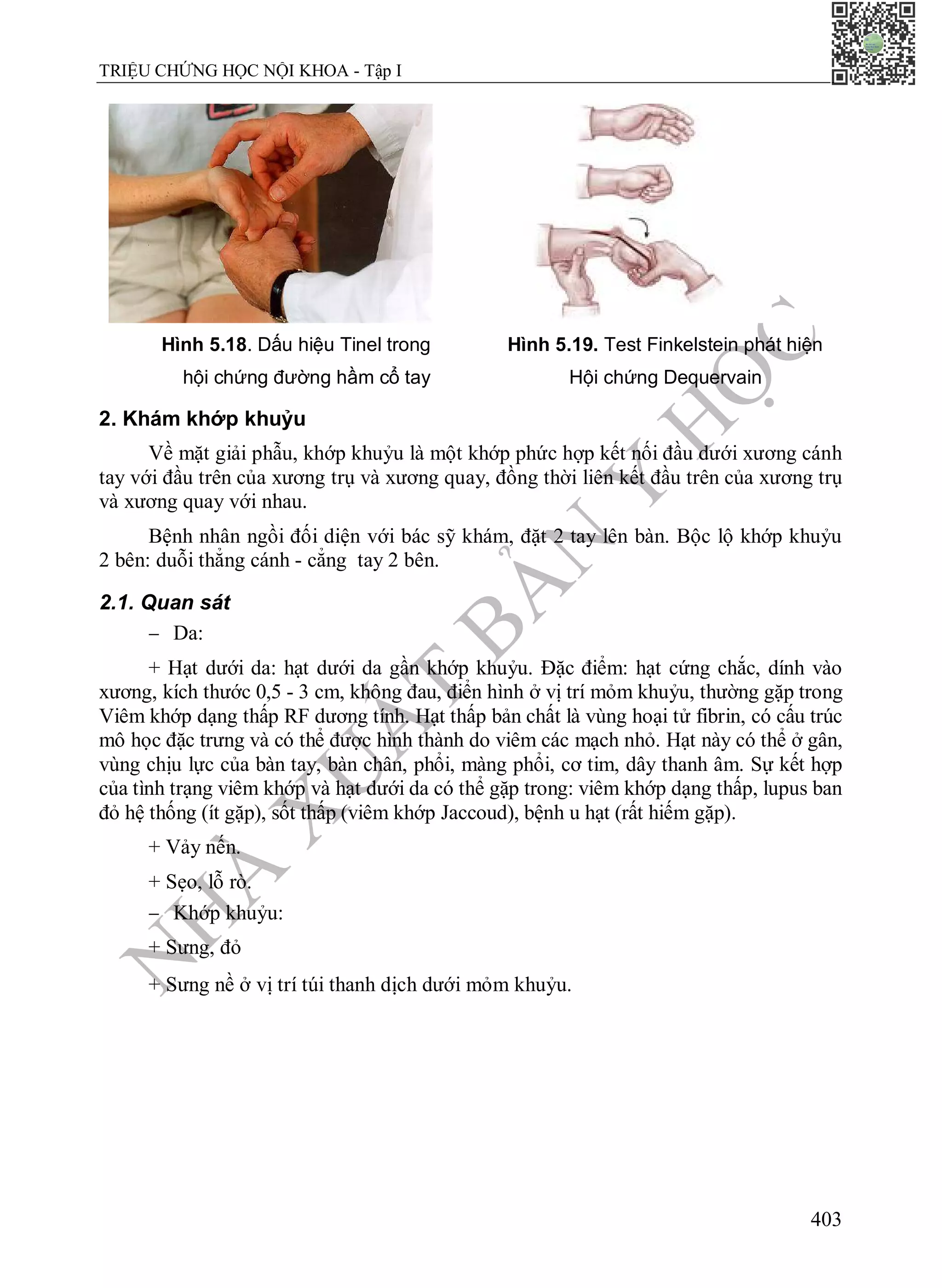 N
H
À
X
U
Ấ
T
B
Ả
N
Y
H
Ọ
C
TRIỆU CHỨNG HỌC NỘI KHOA - Tập I
403
Hình 5.18. Dấu hiệu Tinel trong
hội chứng đường hầm cổ tay
Hình 5.19. Test Finkelstein phát hiện
Hội chứng Dequervain
2. Khám khớp khuỷu
Về mặt giải phẫu, khớp khuỷu là một khớp phức hợp kết nối đầu dưới xương cánh
tay với đầu trên của xương trụ và xương quay, đồng thời liên kết đầu trên của xương trụ
và xương quay với nhau.
Bệnh nhân ngồi đối diện với bác sỹ khám, đặt 2 tay lên bàn. Bộc lộ khớp khuỷu
2 bên: duỗi thẳng cánh - cẳng tay 2 bên.
2.1. Quan sát
 Da:
+ Hạt dưới da: hạt dưới da gần khớp khuỷu. Đặc điểm: hạt cứng chắc, dính vào
xương, kích thước 0,5 - 3 cm, không đau, điển hình ở vị trí mỏm khuỷu, thường gặp trong
Viêm khớp dạng thấp RF dương tính. Hạt thấp bản chất là vùng hoại tử fibrin, có cấu trúc
mô học đặc trưng và có thể được hình thành do viêm các mạch nhỏ. Hạt này có thể ở gân,
vùng chịu lực của bàn tay, bàn chân, phổi, màng phổi, cơ tim, dây thanh âm. Sự kết hợp
của tình trạng viêm khớp và hạt dưới da có thể gặp trong: viêm khớp dạng thấp, lupus ban
đỏ hệ thống (ít gặp), sốt thấp (viêm khớp Jaccoud), bệnh u hạt (rất hiếm gặp).
+ Vảy nến.
+ Sẹo, lỗ rò.
 Khớp khuỷu:
+ Sưng, đỏ
+ Sưng nề ở vị trí túi thanh dịch dưới mỏm khuỷu.
 