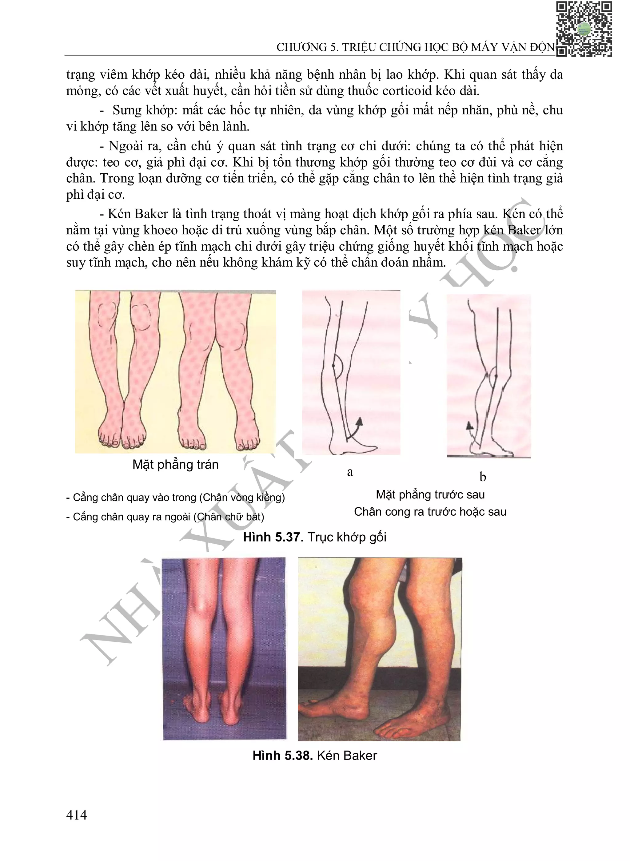 N
H
À
X
U
Ấ
T
B
Ả
N
Y
H
Ọ
C
CHƯƠNG 5. TRIỆU CHỨNG HỌC BỘ MÁY VẬN ĐỘNG
414
trạng viêm khớp kéo dài, nhiều khả năng bệnh nhân bị lao khớp. Khi quan sát thấy da
mỏng, có các vết xuất huyết, cần hỏi tiền sử dùng thuốc corticoid kéo dài.
- Sưng khớp: mất các hốc tự nhiên, da vùng khớp gối mất nếp nhăn, phù nề, chu
vi khớp tăng lên so với bên lành.
- Ngoài ra, cần chú ý quan sát tình trạng cơ chi dưới: chúng ta có thể phát hiện
được: teo cơ, giả phì đại cơ. Khi bị tổn thương khớp gối thường teo cơ đùi và cơ cẳng
chân. Trong loạn dưỡng cơ tiến triển, có thể gặp cẳng chân to lên thể hiện tình trạng giả
phì đại cơ.
- Kén Baker là tình trạng thoát vị màng hoạt dịch khớp gối ra phía sau. Kén có thể
nằm tại vùng khoeo hoặc di trú xuống vùng bắp chân. Một số trường hợp kén Baker lớn
có thể gây chèn ép tĩnh mạch chi dưới gây triệu chứng giống huyết khối tĩnh mạch hoặc
suy tĩnh mạch, cho nên nếu không khám kỹ có thể chẩn đoán nhầm.
Mặt phẳng trán
a b
- Cẳng chân quay vào trong (Chân vòng kiềng)
- Cẳng chân quay ra ngoài (Chân chữ bát)
Mặt phẳng trước sau
Chân cong ra trước hoặc sau
Hình 5.37. Trục khớp gối
Hình 5.38. Kén Baker
 