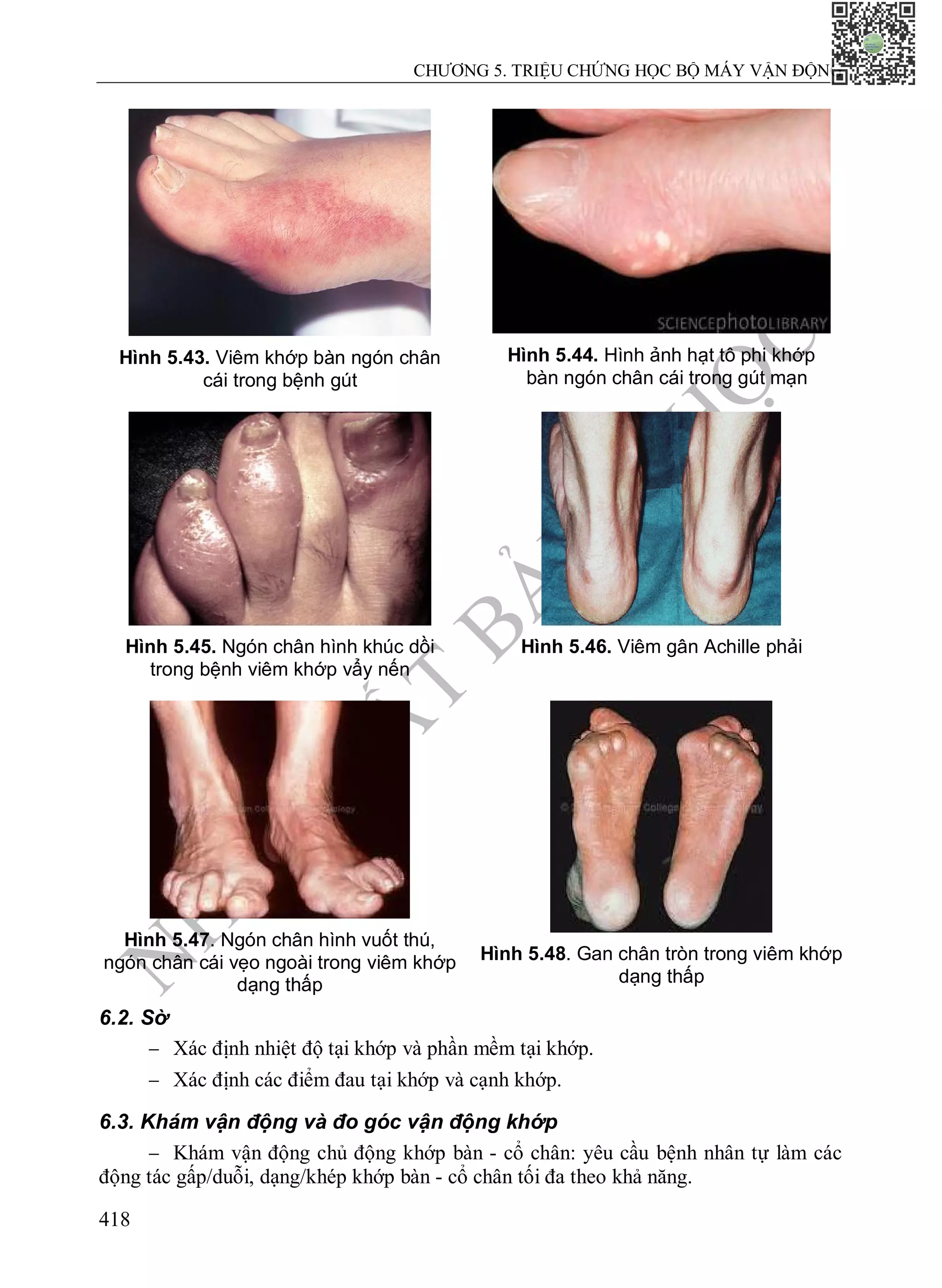 N
H
À
X
U
Ấ
T
B
Ả
N
Y
H
Ọ
C
CHƯƠNG 5. TRIỆU CHỨNG HỌC BỘ MÁY VẬN ĐỘNG
418
Hình 5.43. Viêm khớp bàn ngón chân
cái trong bệnh gút
Hình 5.44. Hình ảnh hạt tô phi khớp
bàn ngón chân cái trong gút mạn
Hình 5.45. Ngón chân hình khúc dồi
trong bệnh viêm khớp vẩy nến
Hình 5.46. Viêm gân Achille phải
Hình 5.47. Ngón chân hình vuốt thú,
ngón chân cái vẹo ngoài trong viêm khớp
dạng thấp
Hình 5.48. Gan chân tròn trong viêm khớp
dạng thấp
6.2. Sờ
 Xác định nhiệt độ tại khớp và phần mềm tại khớp.
 Xác định các điểm đau tại khớp và cạnh khớp.
6.3. Khám vận động và đo góc vận động khớp
 Khám vận động chủ động khớp bàn - cổ chân: yêu cầu bệnh nhân tự làm các
động tác gấp/duỗi, dạng/khép khớp bàn - cổ chân tối đa theo khả năng.
 