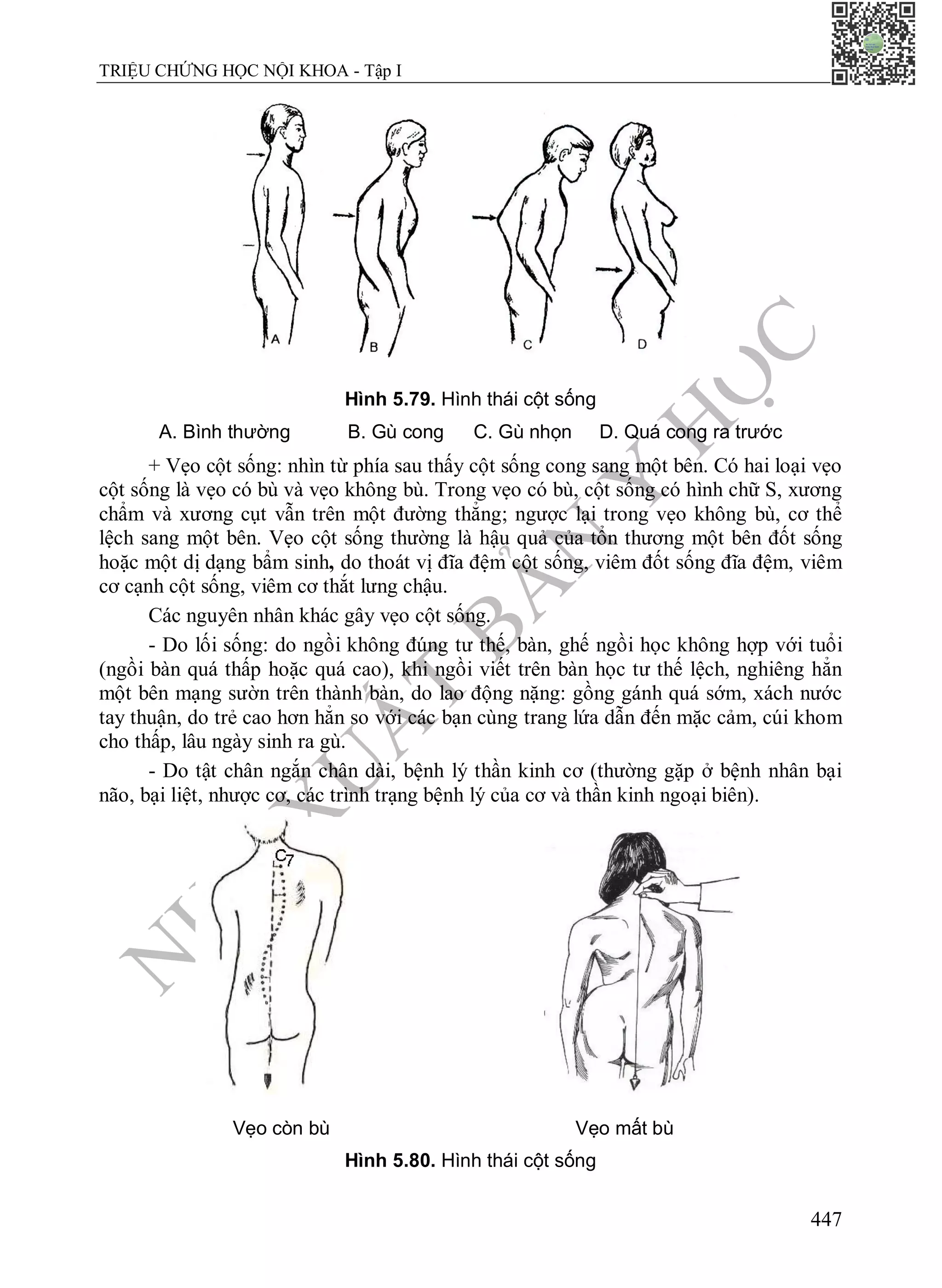 N
H
À
X
U
Ấ
T
B
Ả
N
Y
H
Ọ
C
TRIỆU CHỨNG HỌC NỘI KHOA - Tập I
447
Hình 5.79. Hình thái cột sống
A. Bình thường B. Gù cong C. Gù nhọn D. Quá cong ra trước
+ Vẹo cột sống: nhìn từ phía sau thấy cột sống cong sang một bên. Có hai loại vẹo
cột sống là vẹo có bù và vẹo không bù. Trong vẹo có bù, cột sống có hình chữ S, xương
chẩm và xương cụt vẫn trên một đường thẳng; ngược lại trong vẹo không bù, cơ thể
lệch sang một bên. Vẹo cột sống thường là hậu quả của tổn thương một bên đốt sống
hoặc một dị dạng bẩm sinh, do thoát vị đĩa đệm cột sống, viêm đốt sống đĩa đệm, viêm
cơ cạnh cột sống, viêm cơ thắt lưng chậu.
Các nguyên nhân khác gây vẹo cột sống.
- Do lối sống: do ngồi không đúng tư thế, bàn, ghế ngồi học không hợp với tuổi
(ngồi bàn quá thấp hoặc quá cao), khi ngồi viết trên bàn học tư thế lệch, nghiêng hẳn
một bên mạng sườn trên thành bàn, do lao động nặng: gồng gánh quá sớm, xách nước
tay thuận, do trẻ cao hơn hẳn so với các bạn cùng trang lứa dẫn đến mặc cảm, cúi khom
cho thấp, lâu ngày sinh ra gù.
- Do tật chân ngắn chân dài, bệnh lý thần kinh cơ (thường gặp ở bệnh nhân bại
não, bại liệt, nhược cơ, các trình trạng bệnh lý của cơ và thần kinh ngoại biên).
Vẹo còn bù Vẹo mất bù
Hình 5.80. Hình thái cột sống
 