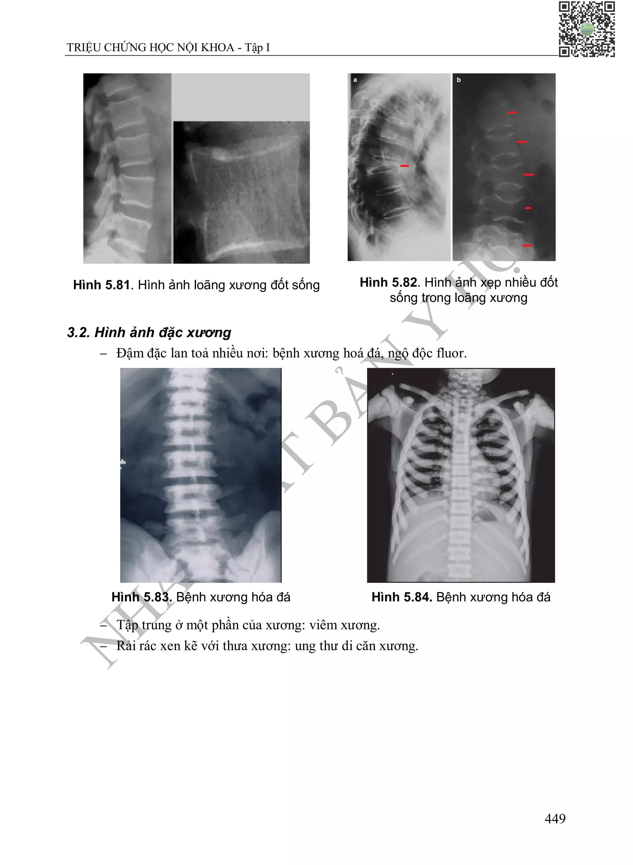N
H
À
X
U
Ấ
T
B
Ả
N
Y
H
Ọ
C
TRIỆU CHỨNG HỌC NỘI KHOA - Tập I
449
Hình 5.81. Hình ảnh loãng xương đốt sống Hình 5.82. Hình ảnh xẹp nhiều đốt
sống trong loãng xương
3.2. Hình ảnh đặc xương
 Đậm đặc lan toả nhiều nơi: bệnh xương hoá đá, ngộ độc fluor.
Hình 5.83. Bệnh xương hóa đá Hình 5.84. Bệnh xương hóa đá
 Tập trung ở một phần của xương: viêm xương.
 Rải rác xen kẽ với thưa xương: ung thư di căn xương.
 