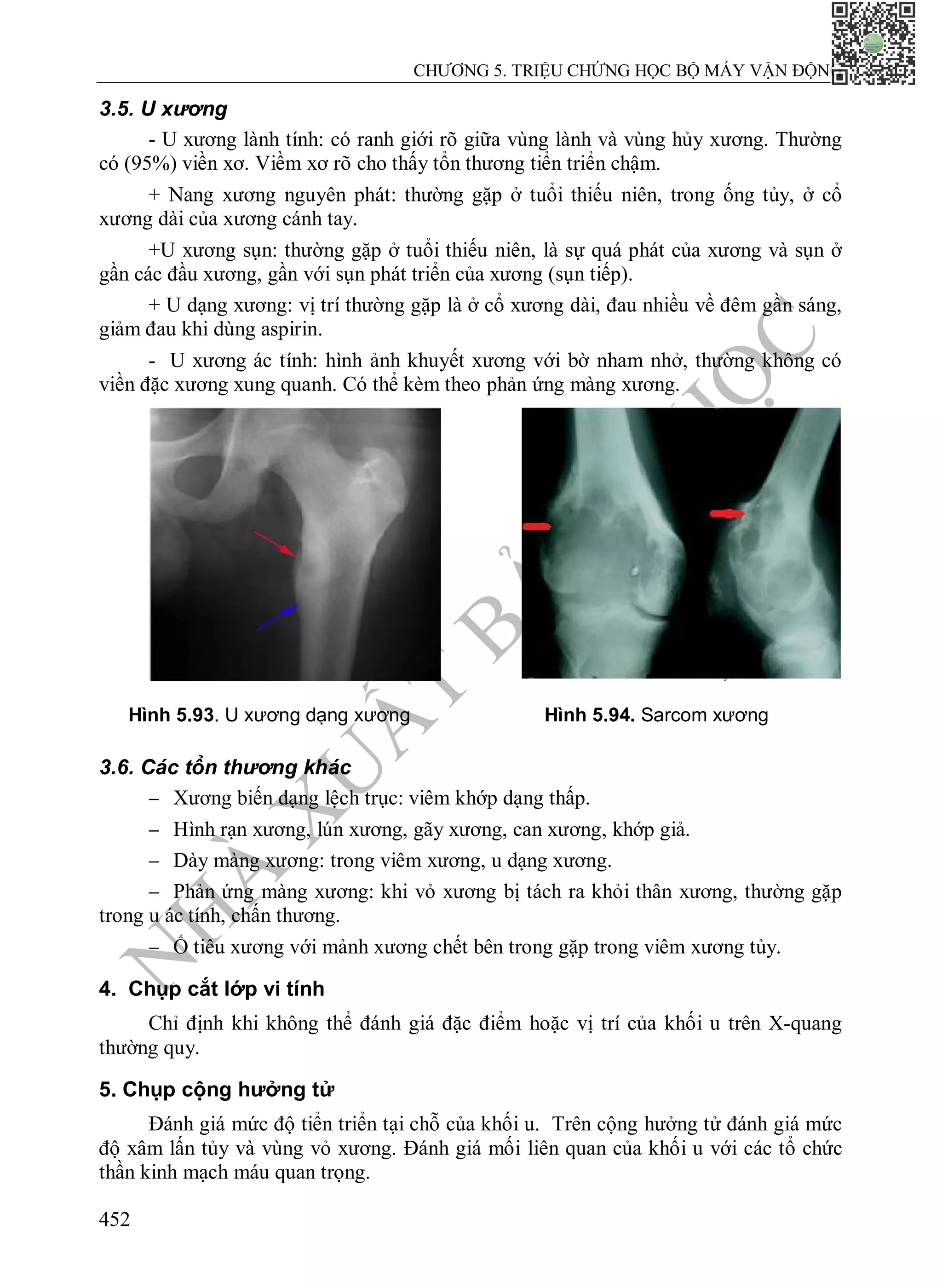 N
H
À
X
U
Ấ
T
B
Ả
N
Y
H
Ọ
C
CHƯƠNG 5. TRIỆU CHỨNG HỌC BỘ MÁY VẬN ĐỘNG
452
3.5. U xương
- U xương lành tính: có ranh giới rõ giữa vùng lành và vùng hủy xương. Thường
có (95%) viền xơ. Viềm xơ rõ cho thấy tổn thương tiển triển chậm.
+ Nang xương nguyên phát: thường gặp ở tuổi thiếu niên, trong ống tủy, ở cổ
xương dài của xương cánh tay.
+U xương sụn: thường gặp ở tuổi thiếu niên, là sự quá phát của xương và sụn ở
gần các đầu xương, gần với sụn phát triển của xương (sụn tiếp).
+ U dạng xương: vị trí thường gặp là ở cổ xương dài, đau nhiều về đêm gần sáng,
giảm đau khi dùng aspirin.
- U xương ác tính: hình ảnh khuyết xương với bờ nham nhở, thường không có
viền đặc xương xung quanh. Có thể kèm theo phản ứng màng xương.
Hình 5.93. U xương dạng xương Hình 5.94. Sarcom xương
3.6. Các tổn thương khác
 Xương biến dạng lệch trục: viêm khớp dạng thấp.
 Hình rạn xương, lún xương, gãy xương, can xương, khớp giả.
 Dày màng xương: trong viêm xương, u dạng xương.
 Phản ứng màng xương: khi vỏ xương bị tách ra khỏi thân xương, thường gặp
trong u ác tính, chấn thương.
 Ổ tiêu xương với mảnh xương chết bên trong gặp trong viêm xương tủy.
4. Chụp cắt lớp vi tính
Chỉ định khi không thể đánh giá đặc điểm hoặc vị trí của khối u trên X-quang
thường quy.
5. Chụp cộng hưởng tử
Đánh giá mức độ tiển triển tại chỗ của khối u. Trên cộng hưởng tử đánh giá mức
độ xâm lấn tủy và vùng vỏ xương. Đánh giá mối liên quan của khối u với các tổ chức
thần kinh mạch máu quan trọng.
 