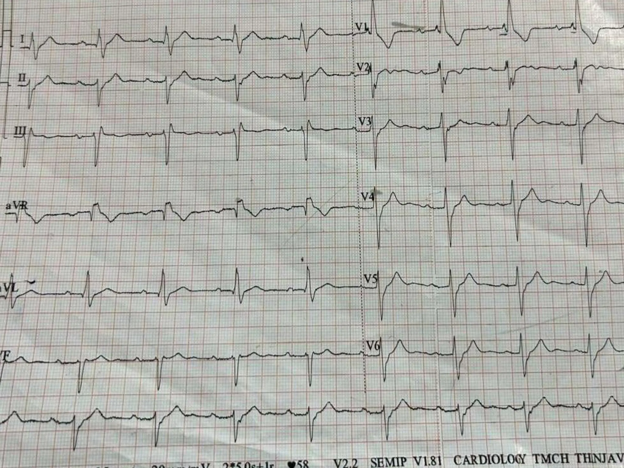 TRIFASCICULAR BLOCK ECG Presentation.pptx