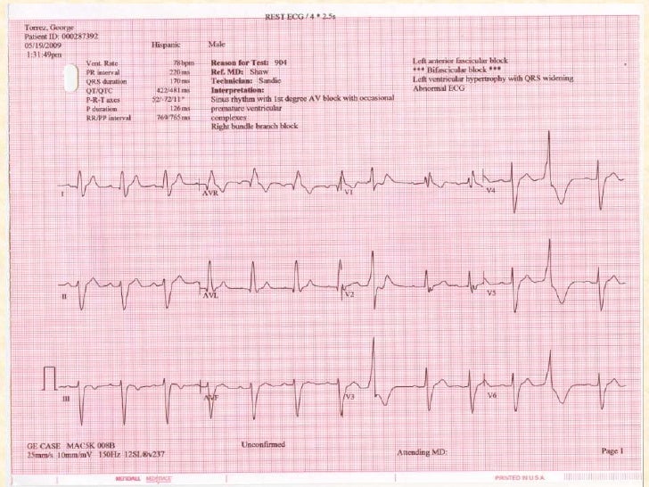 Trifascicular Block Presentation