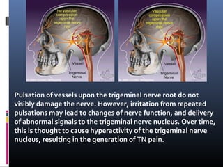 Pulsation of vessels upon the trigeminal nerve root do not
visibly damage the nerve. However, irritation from repeated
pulsations may lead to changes of nerve function, and delivery
of abnormal signals to the trigeminal nerve nucleus. Over time,
this is thought to cause hyperactivity of the trigeminal nerve
nucleus, resulting in the generation of TN pain.

 