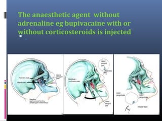The anaesthetic agent without
adrenaline eg bupivacaine with or
without corticosteroids is injected
 .

 