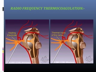 RADIO FREQUENCY THERMOCOAGULATION:-

 