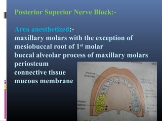 Posterior Superior Nerve Block:Area anesthetized:maxillary molars with the exception of
mesiobuccal root of 1st molar
buccal alveolar process of maxillary molars
periosteum
connective tissue
mucous membrane

 
