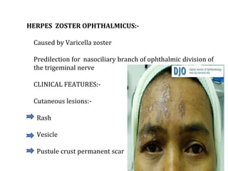 HERPES ZOSTER OPHTHALMICUS:-
Caused by Varicella zoster
Predilection for nasociliary branch of ophthalmic division of
the trigeminal nerve
CLINICAL FEATURES:-
Cutaneous lesions:-
Rash
Vesicle
Pustule crust permanent scar
 