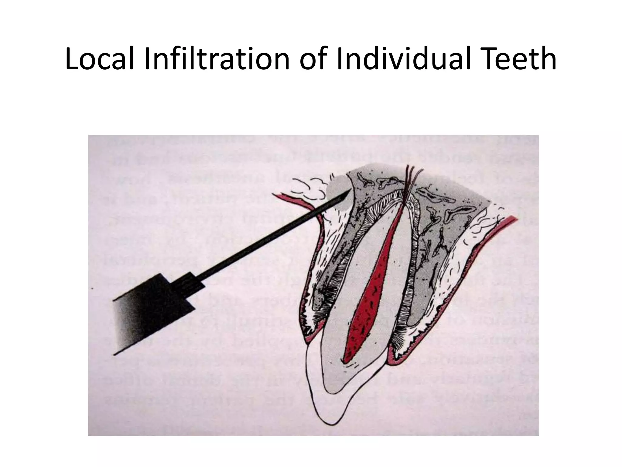 Local Infiltration of Individual Teeth
 
