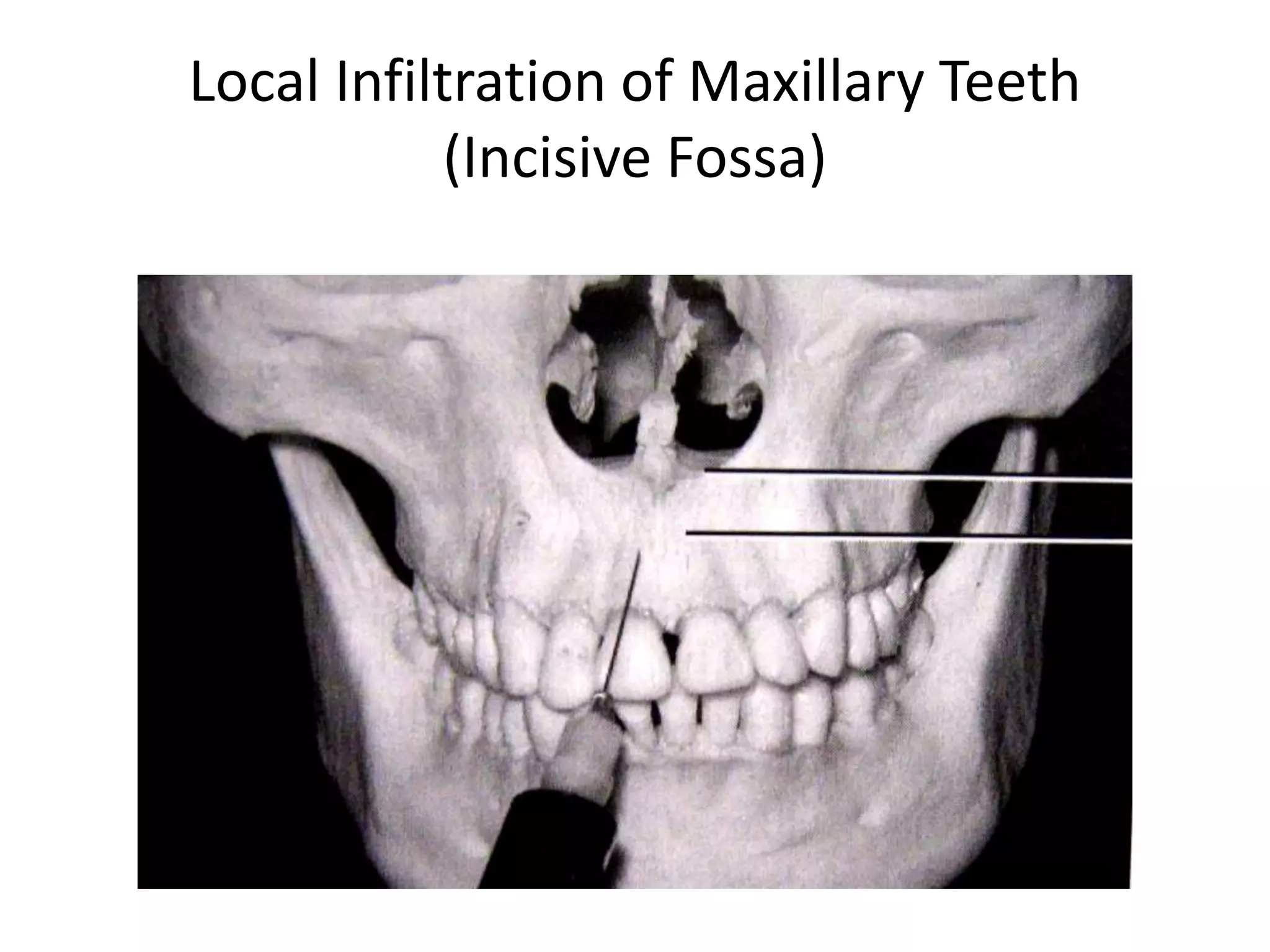 Local Infiltration of Maxillary Teeth
(Incisive Fossa)
 