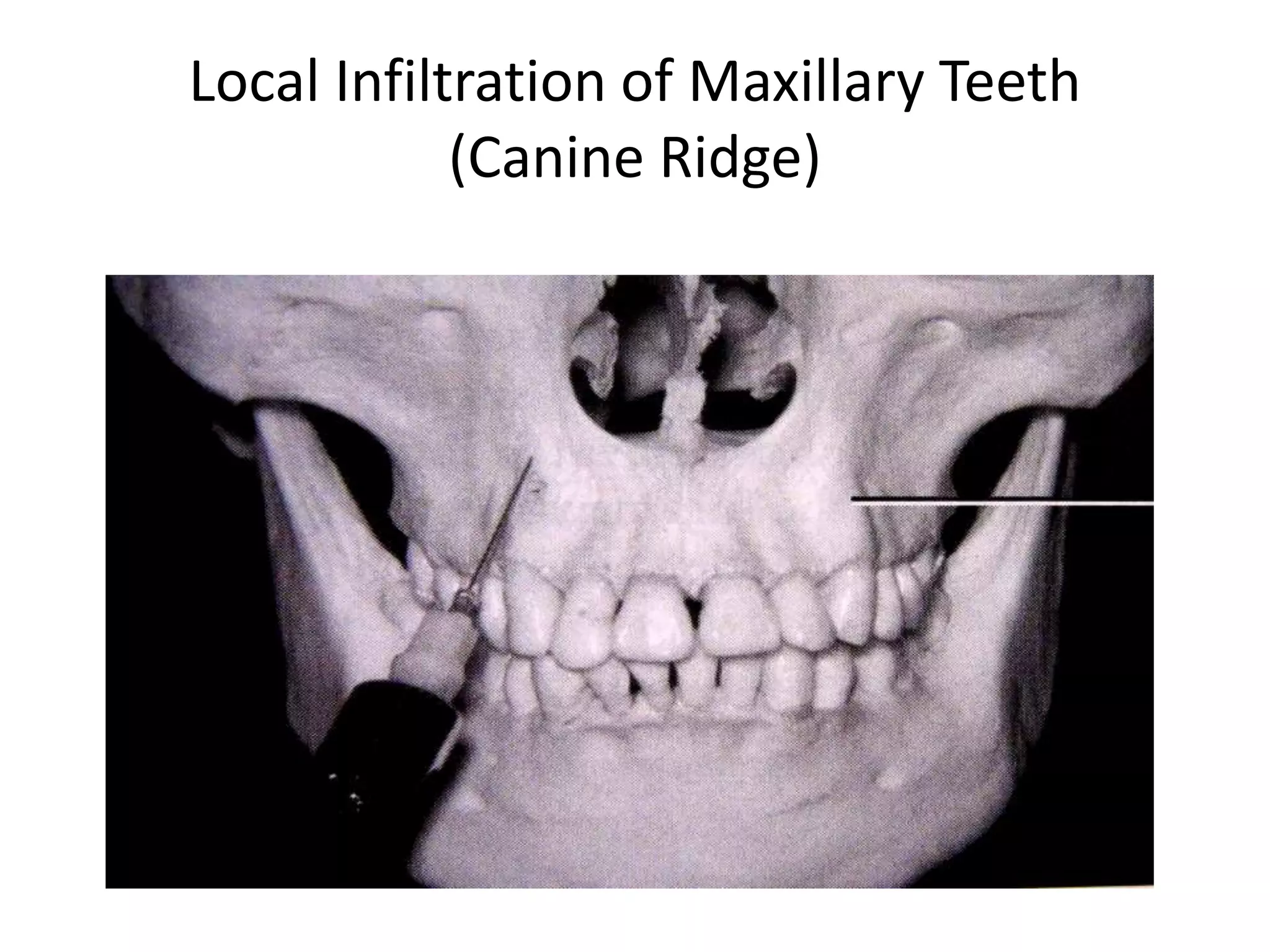 Local Infiltration of Maxillary Teeth
(Canine Ridge)
 