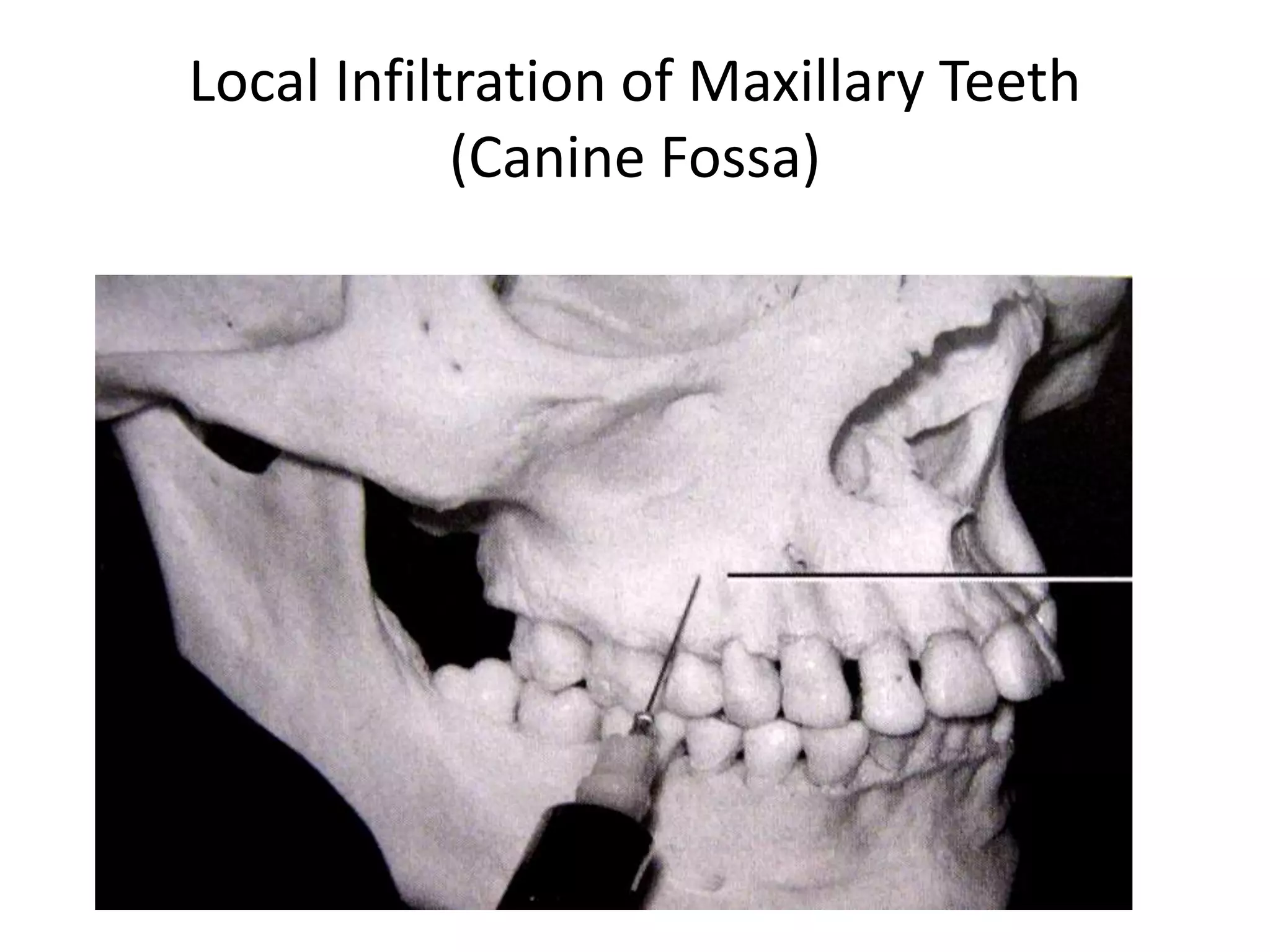 Local Infiltration of Maxillary Teeth
(Canine Fossa)
 