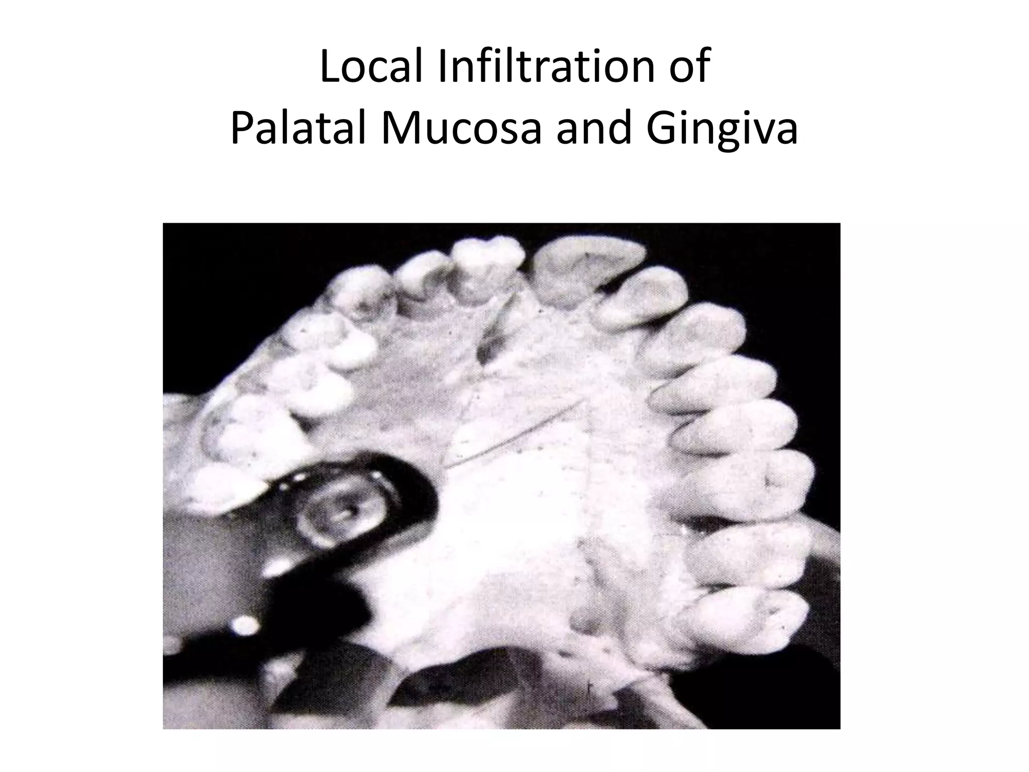 Local Infiltration of
Palatal Mucosa and Gingiva
 