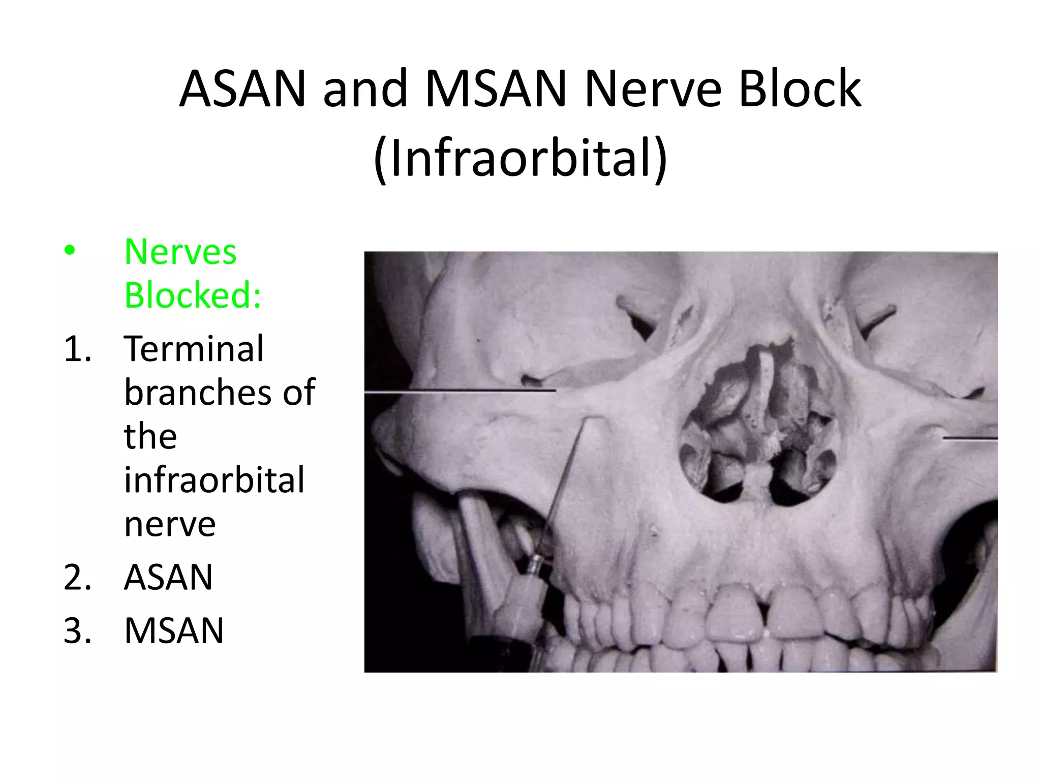 ASAN and MSAN Nerve Block
(Infraorbital)
• Nerves
Blocked:
1. Terminal
branches of
the
infraorbital
nerve
2. ASAN
3. MSAN
 
