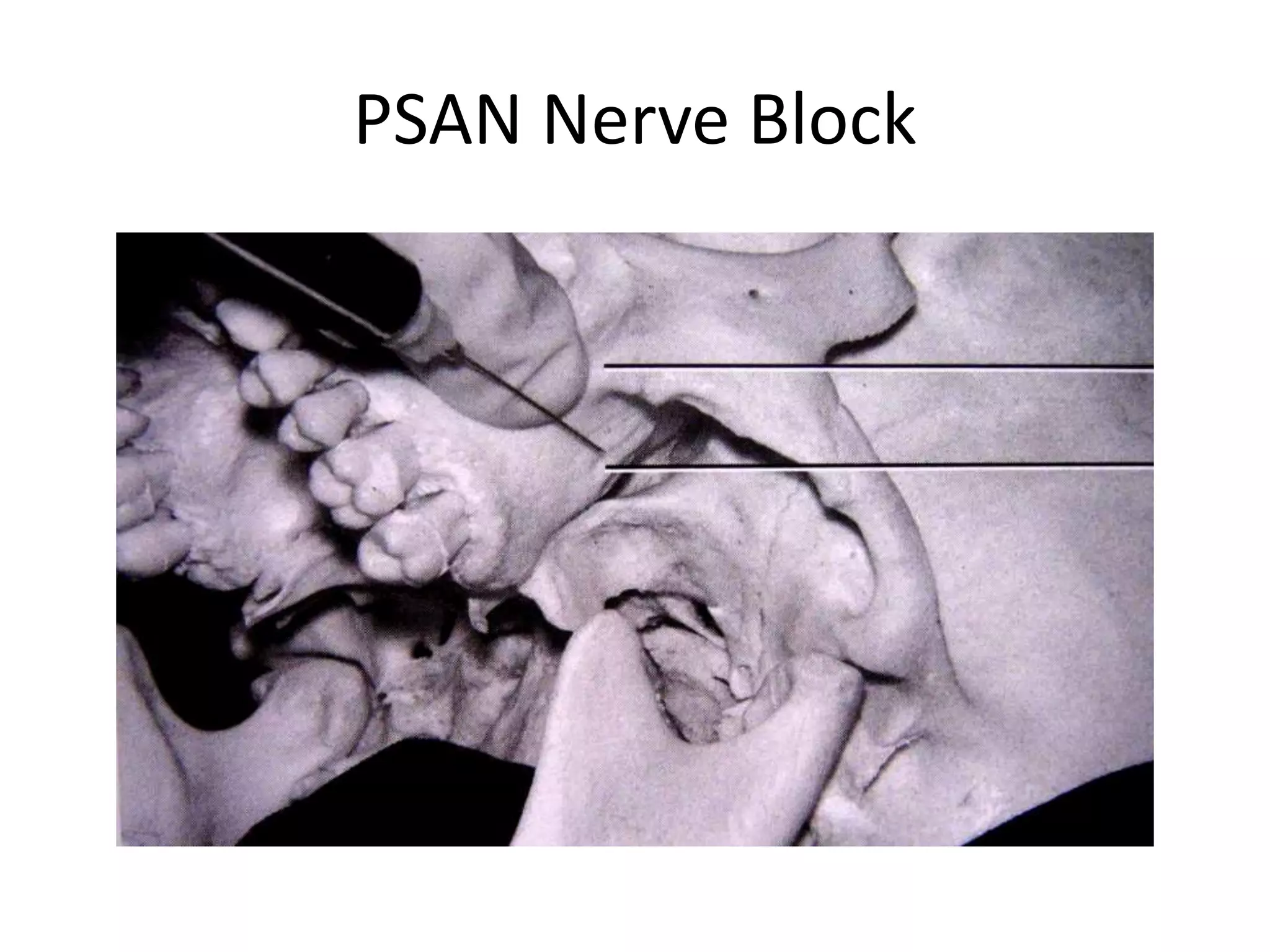PSAN Nerve Block
 