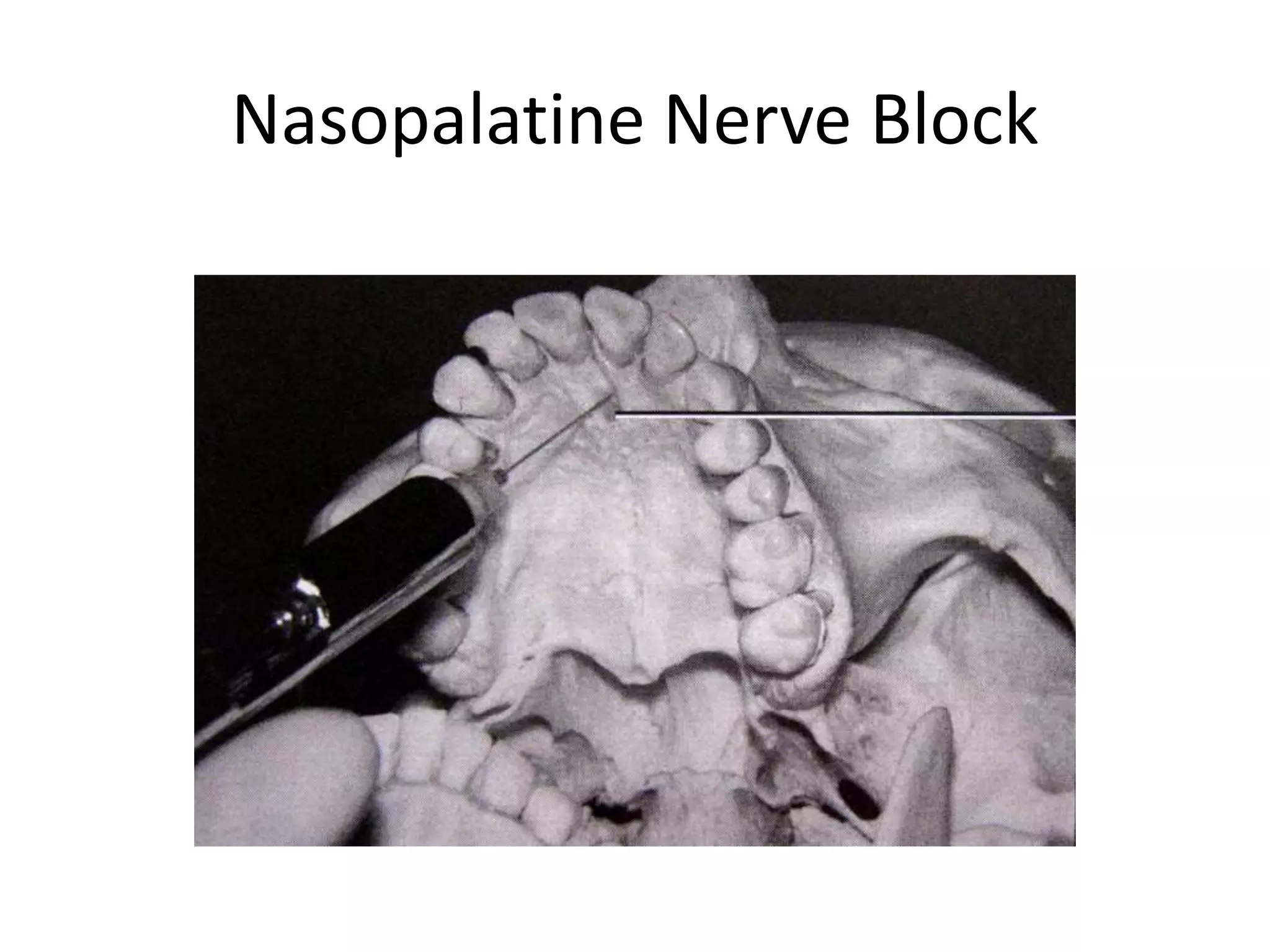 Nasopalatine Nerve Block
 