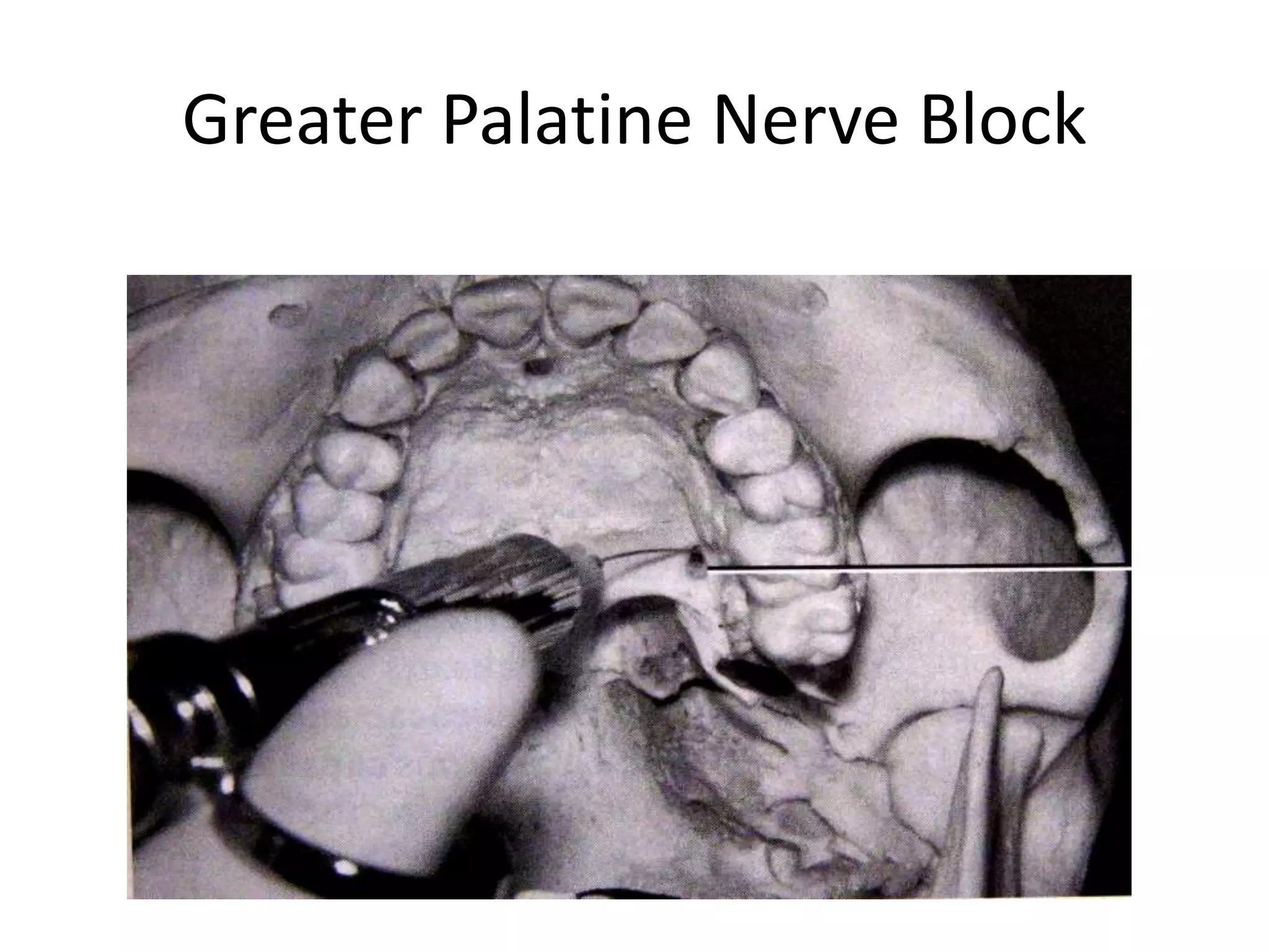 Greater Palatine Nerve Block
 